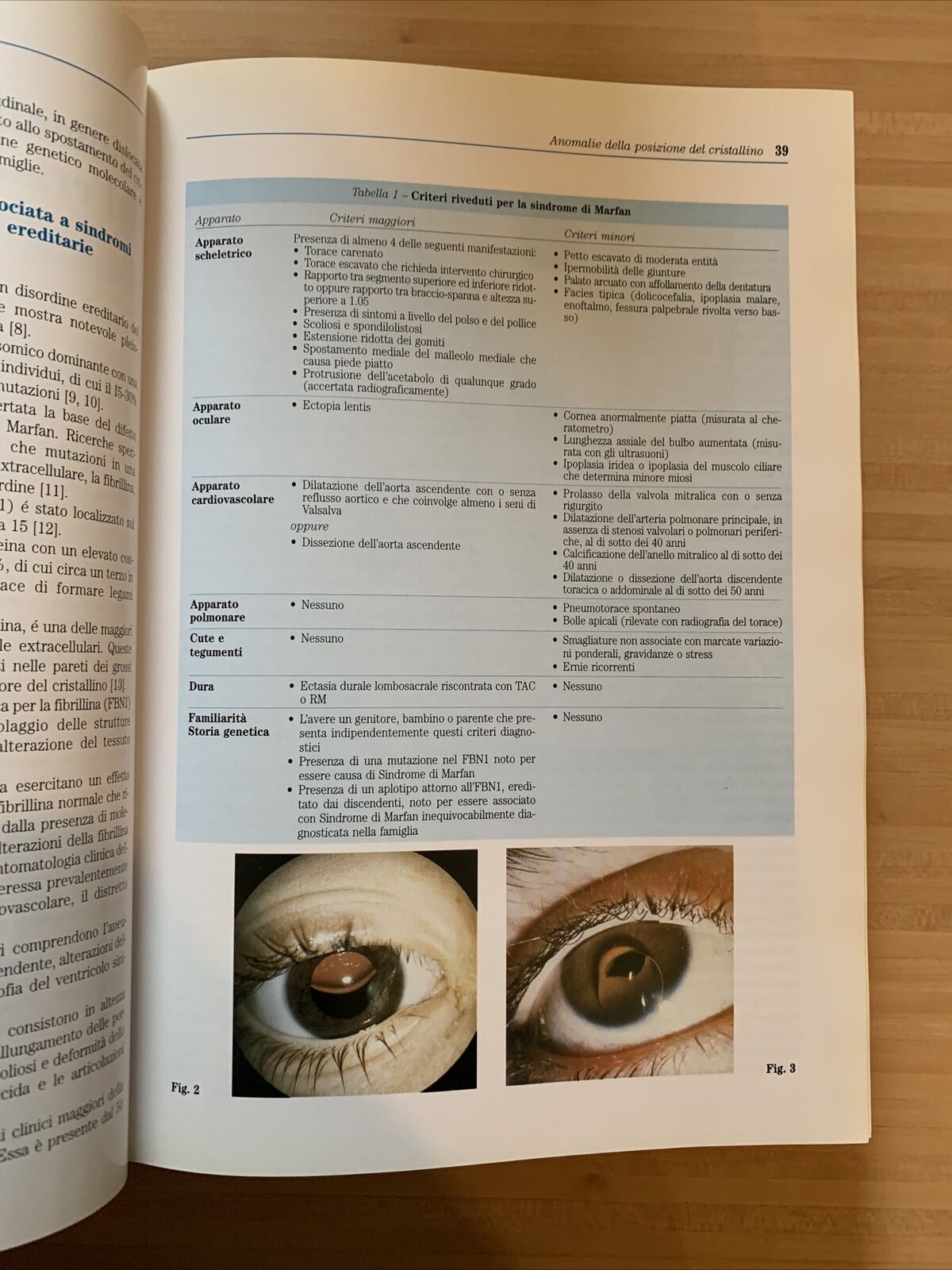 CATARATTA fisiopatologia del cristallino chirurgia della Cataratta.Fabiano 1999