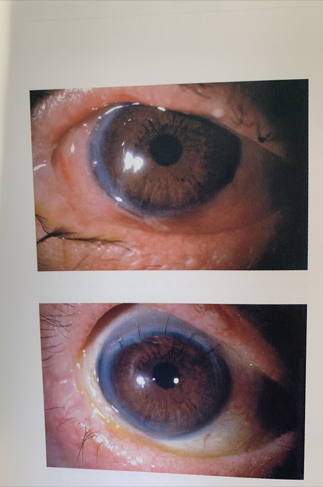 Inflammation chronique de la conjonctive, Thanh Hoang-Xuan, Hannouche, Badouin