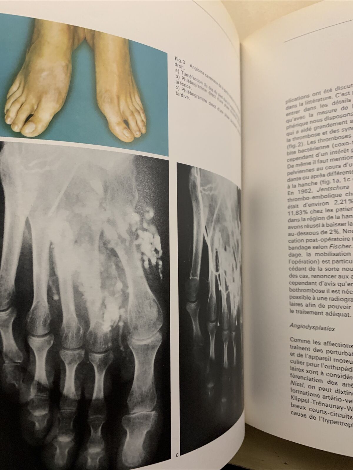 FORUM MEDICI - LES MÉDICINS PARLENT AU MÉDECIN, No 14 La phlébologie et les doma