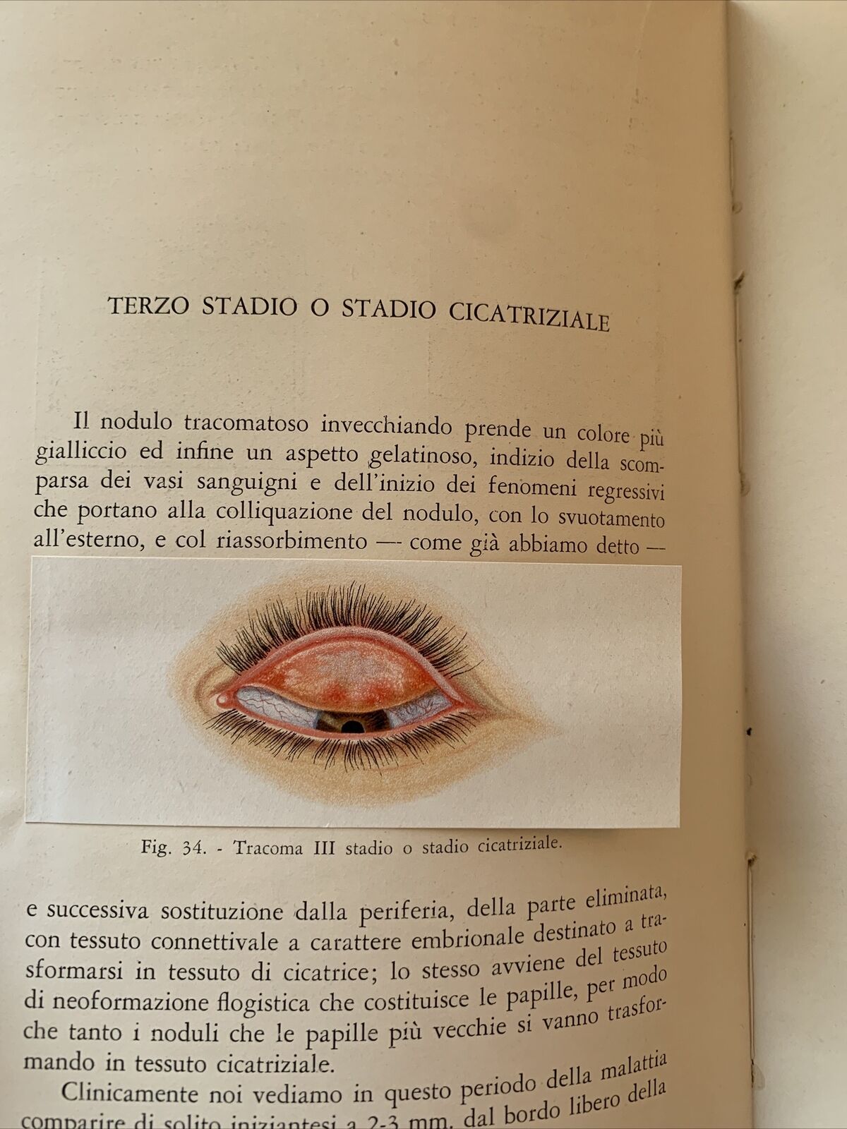 IL TRACOMA - BARDELLI , MARZOCCO 1940