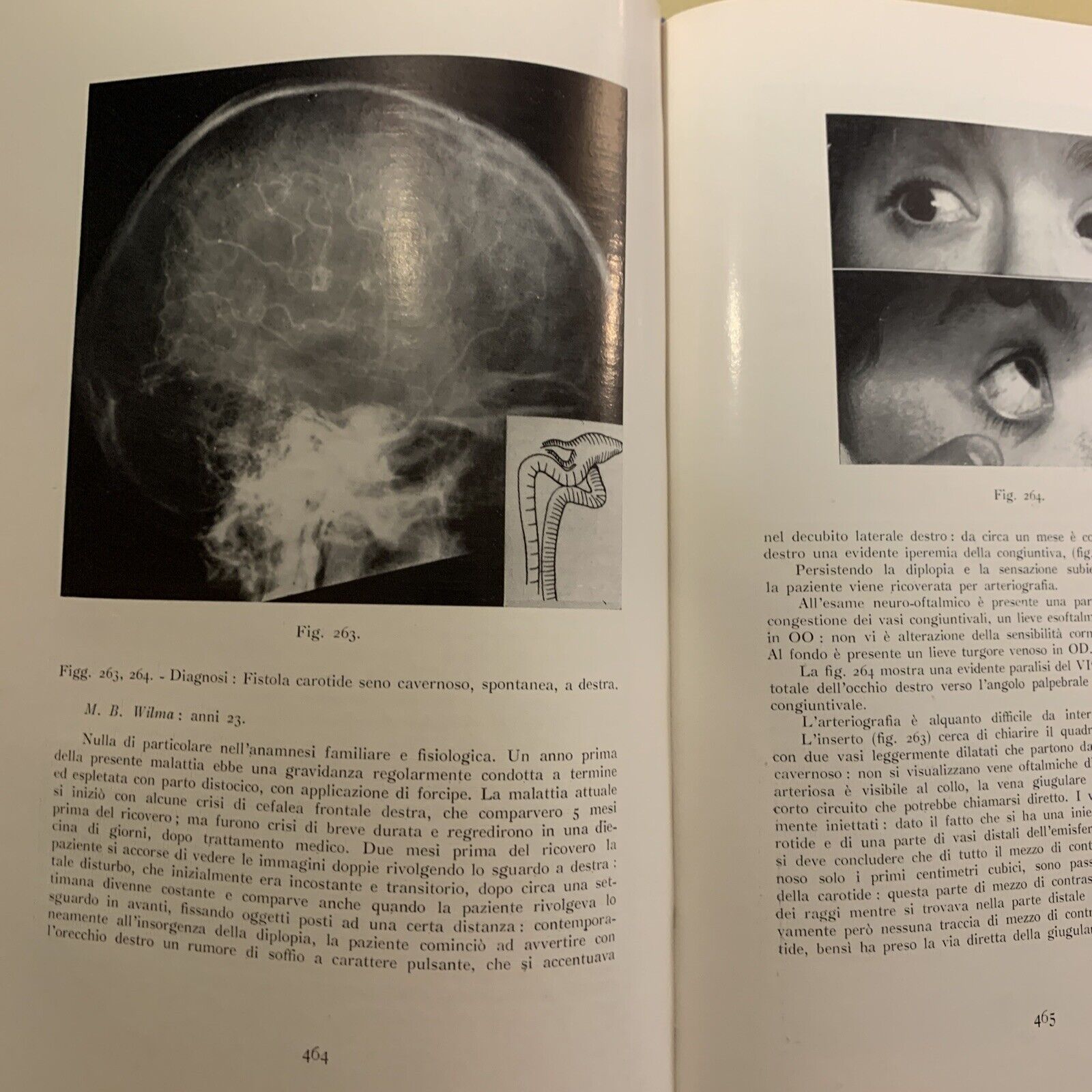 ANGIOGRAFIA CEREBRALE - MARIO MILLETTI, VOLUME PRIMO. LUIGI PARMA 1959