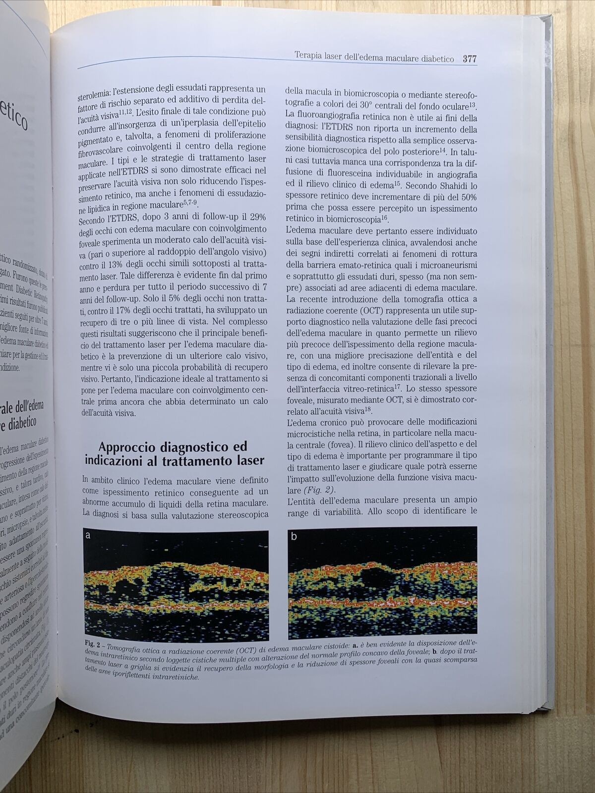 Chirurgia della Macula, Fabiano editore. Società oftalmologica italiana 2001 #