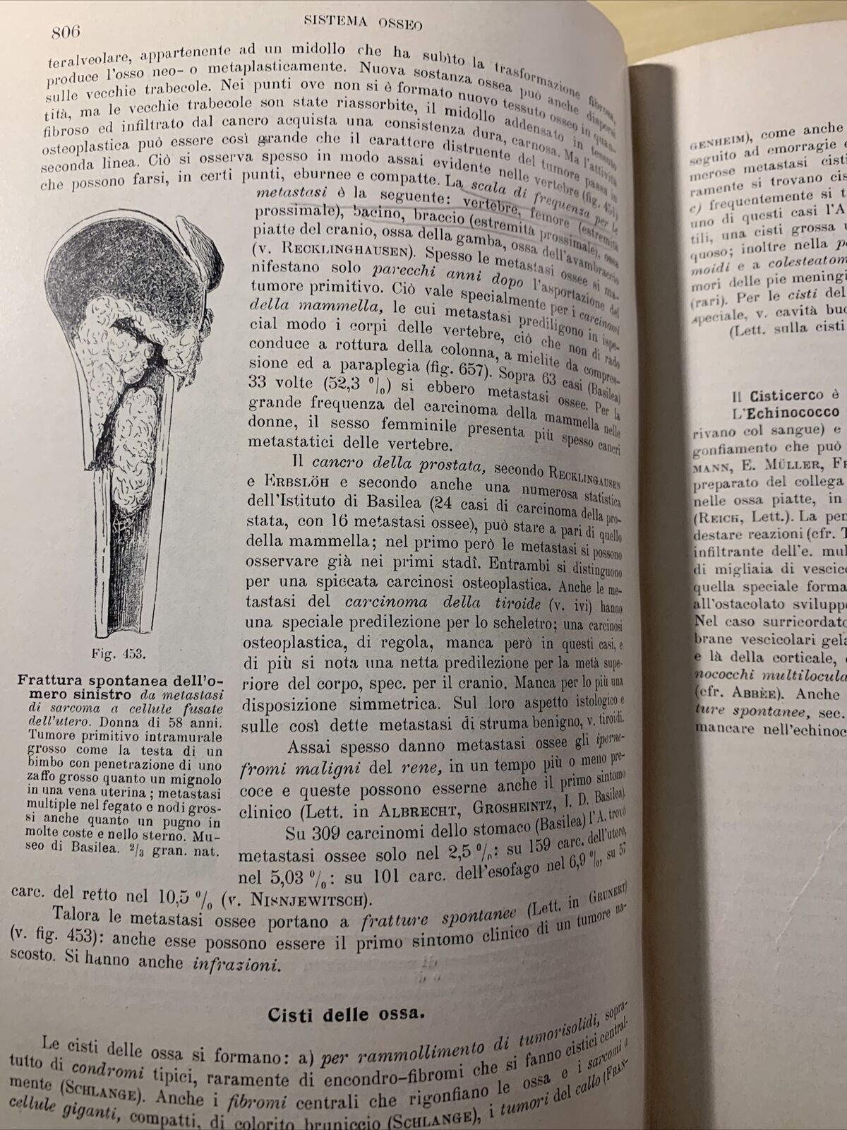 Trattato di ANATOMIA PATOLOGICA SPECIALE - Kaufmann E. Vallardi 1913 2 voll. #