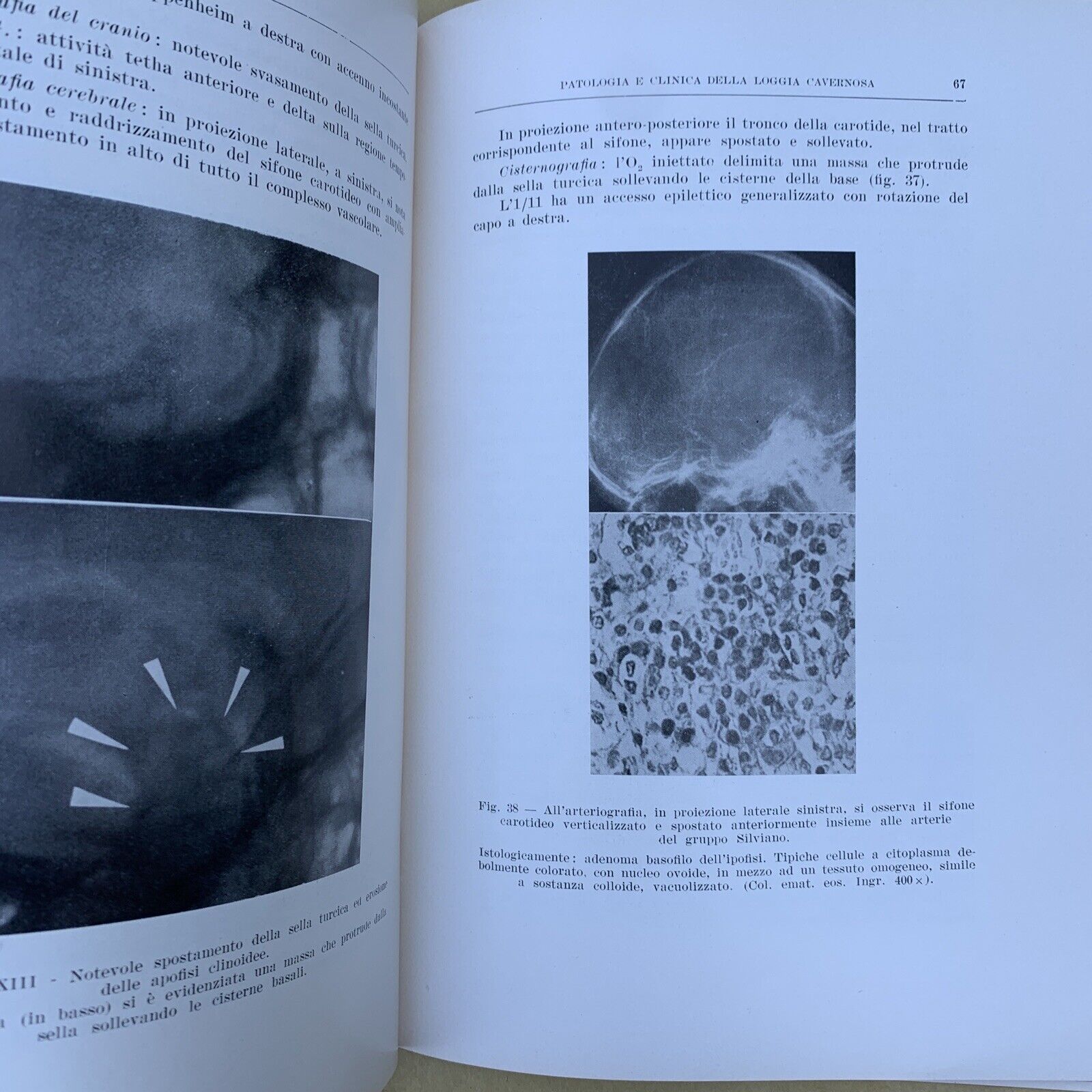 Patologia e clinica della loggia cavernosa, Aldo Martelli Oto neuro oftalmologia