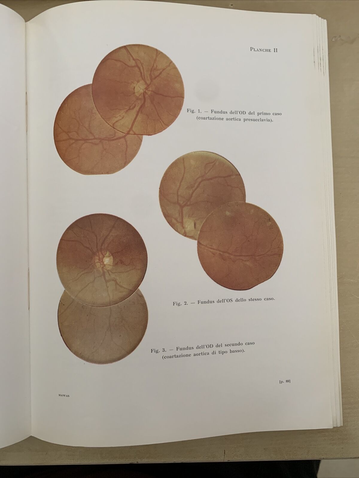 TRAVAUX D'OPHTALMOLOGIE MODERNE - Mawas Jacques - Masson et Cie 1966 #