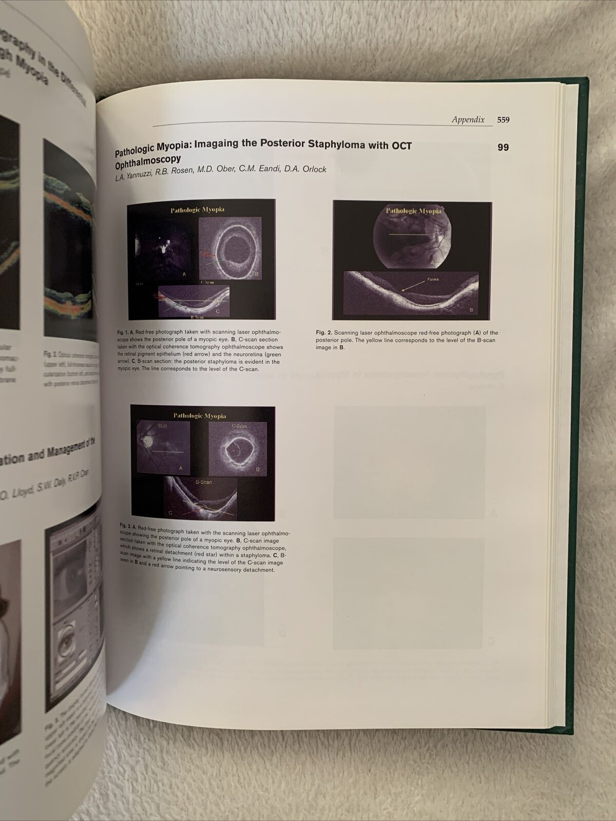 MYOPIA AND RELATED DISEASES. EDOARDO MIDENA. G. B. BIETTI 2005 OFTALMOLOGIA