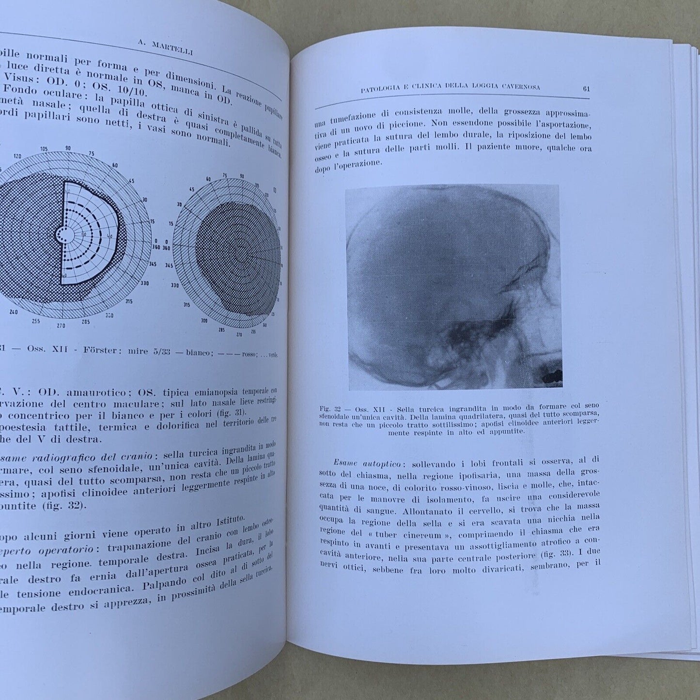 Patologia e clinica della loggia cavernosa, Aldo Martelli Oto neuro oftalmologia