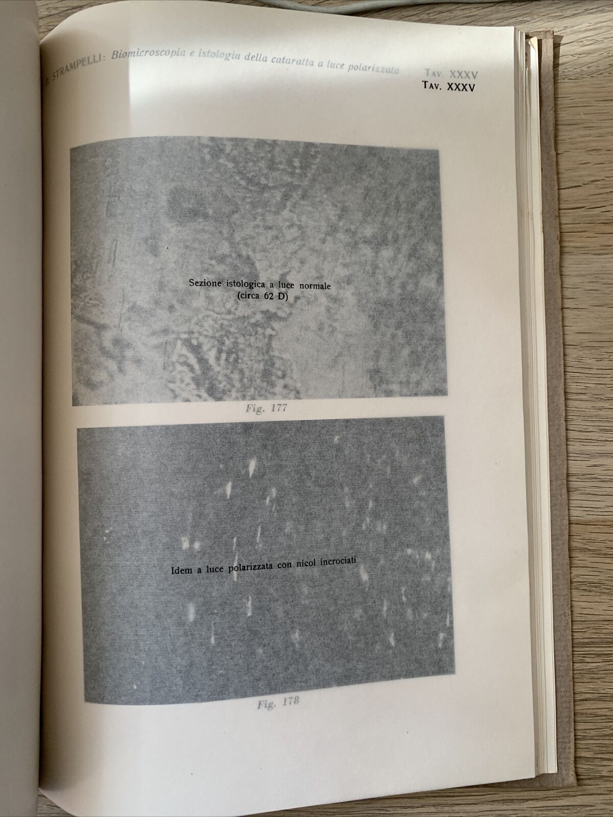 BIOMICROSCOPIA ED ISTOLOGIA DELLA CATARATTA A LUCE POLARIZZATA - Strampelli 1934