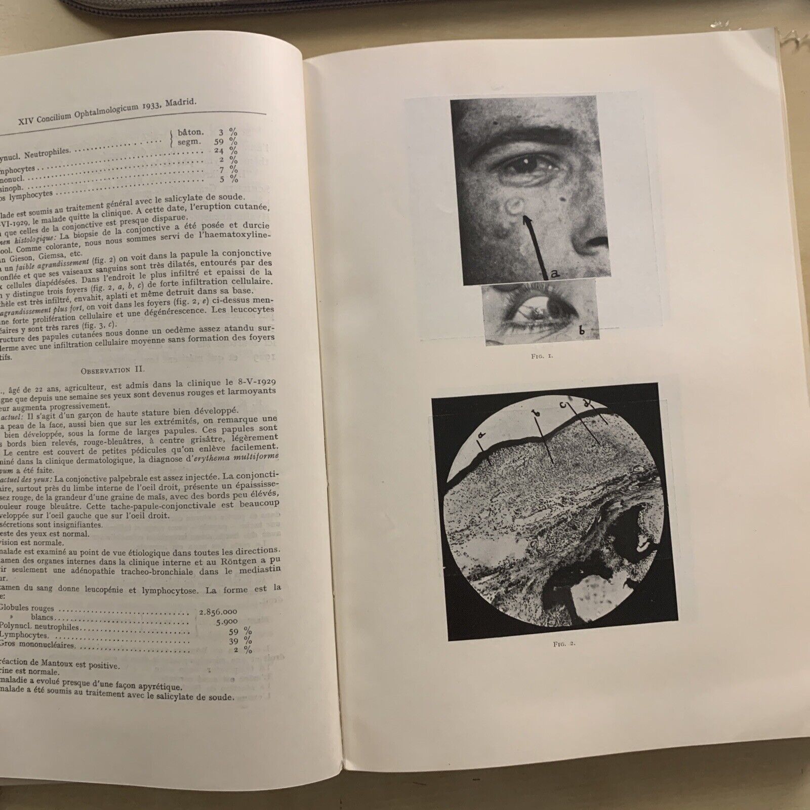 TUBERCULOSIS DEL IRIS Y DEL CUERPO CILIAR - concilium ophtalmologicum 1933 #