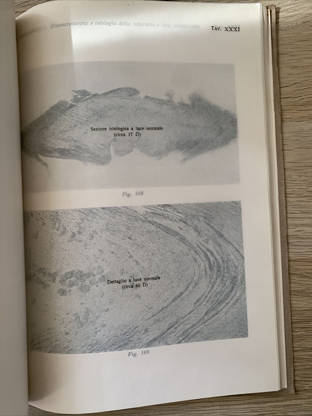 BIOMICROSCOPIA ED ISTOLOGIA DELLA CATARATTA A LUCE POLARIZZATA - Strampelli 1934