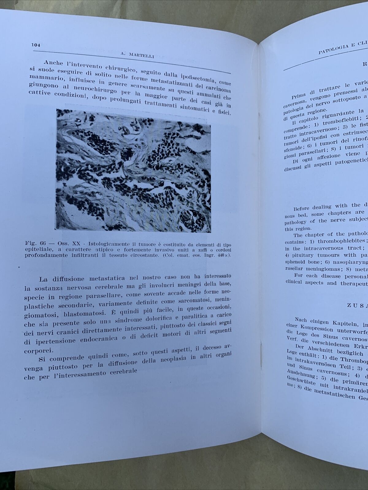 Patologia e clinica della loggia cavernosa, Aldo Martelli Oto neuro oftalmologia