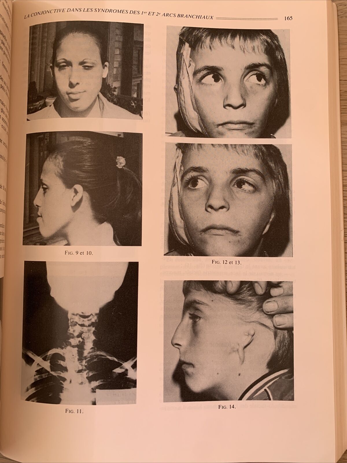 Bulletins et mémoires de la Société francaise d'Ophtalmologie - Masson 1982 #