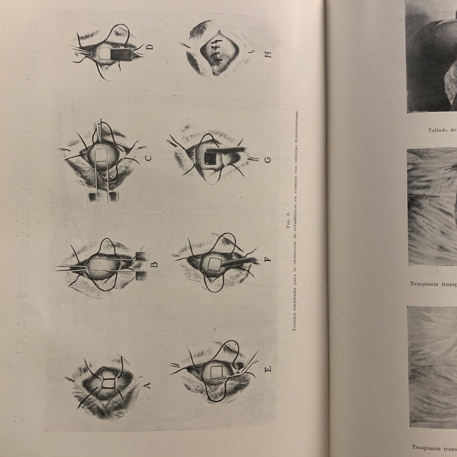 TUBERCULOSIS DEL IRIS Y DEL CUERPO CILIAR - concilium ophtalmologicum 1933 #