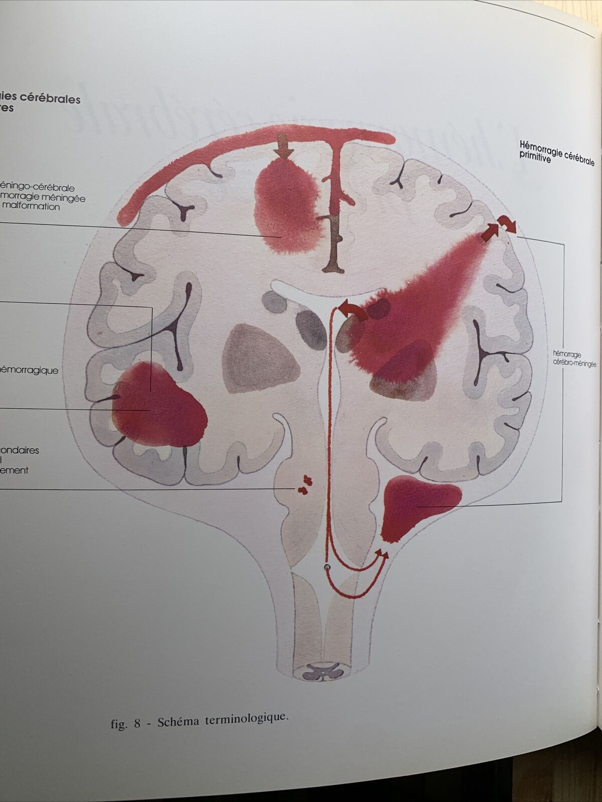 Redécouverte du micro anéurysme - Robert et Carrière, hypertension artirielle #