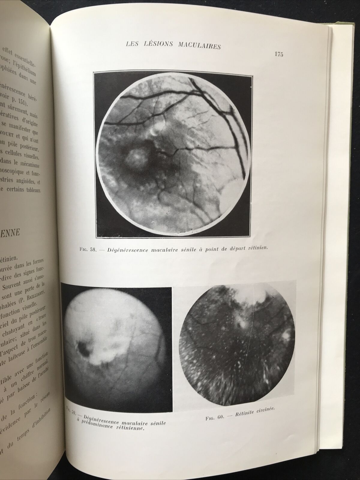 LES AFFECTIONS DE LA MACULA, Jean P. Bailliart - Masson & Cie