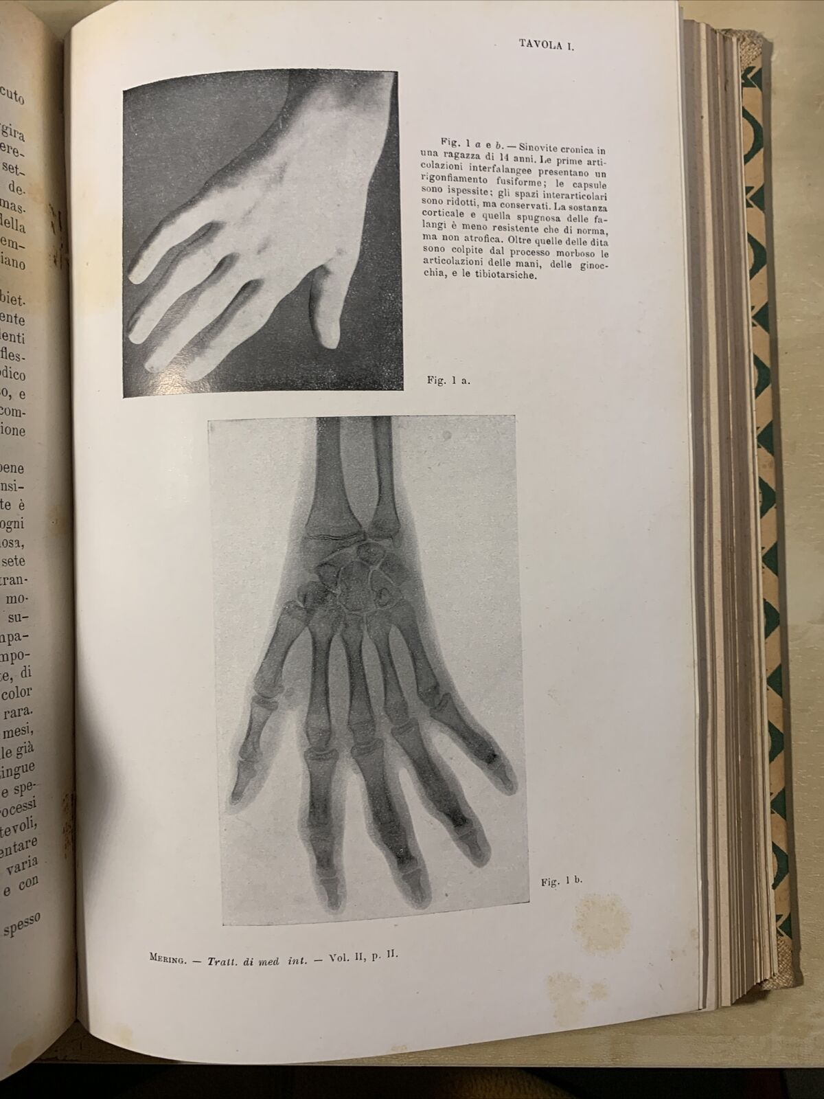 TRATTATO DELLE MALATTIE INTERNE, J. v. Mering. Società Editrice Libraria 1926