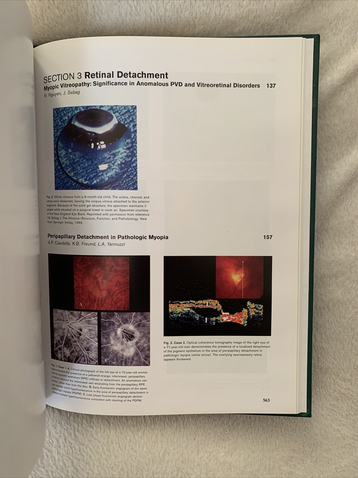 MYOPIA AND RELATED DISEASES. EDOARDO MIDENA. G. B. BIETTI 2005 OFTALMOLOGIA