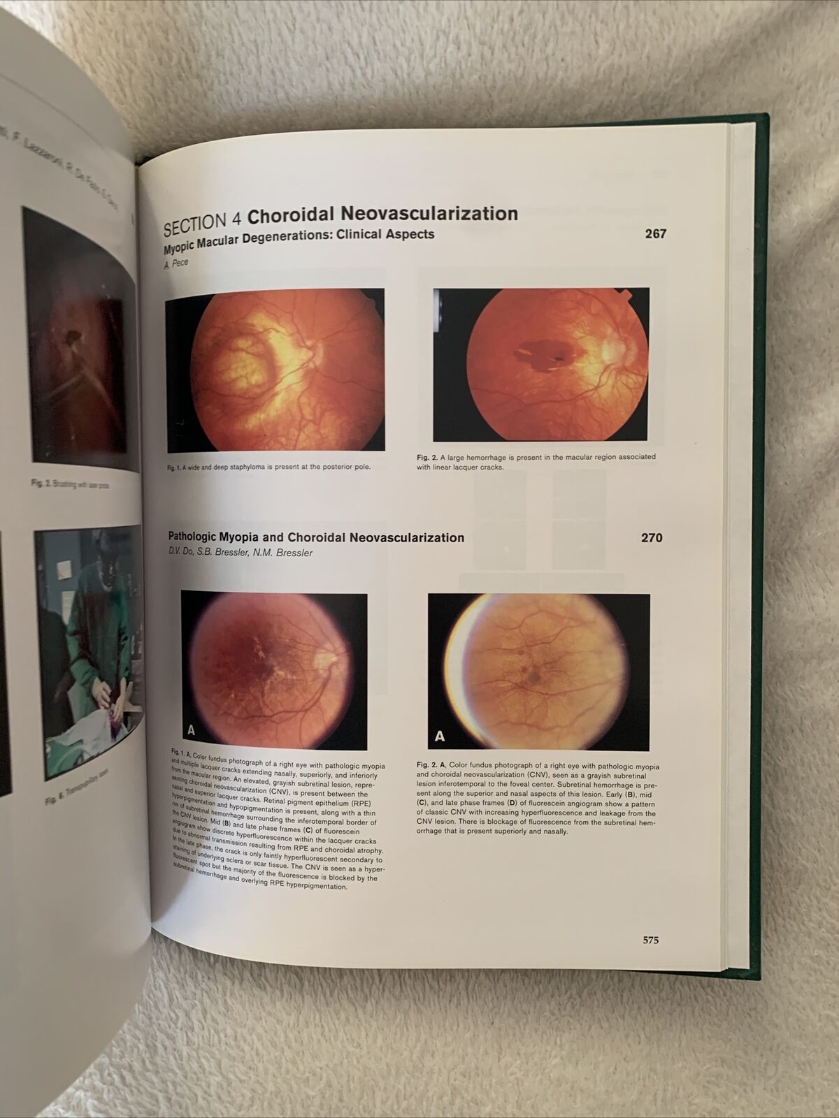 MYOPIA AND RELATED DISEASES. EDOARDO MIDENA. G. B. BIETTI 2005 OFTALMOLOGIA