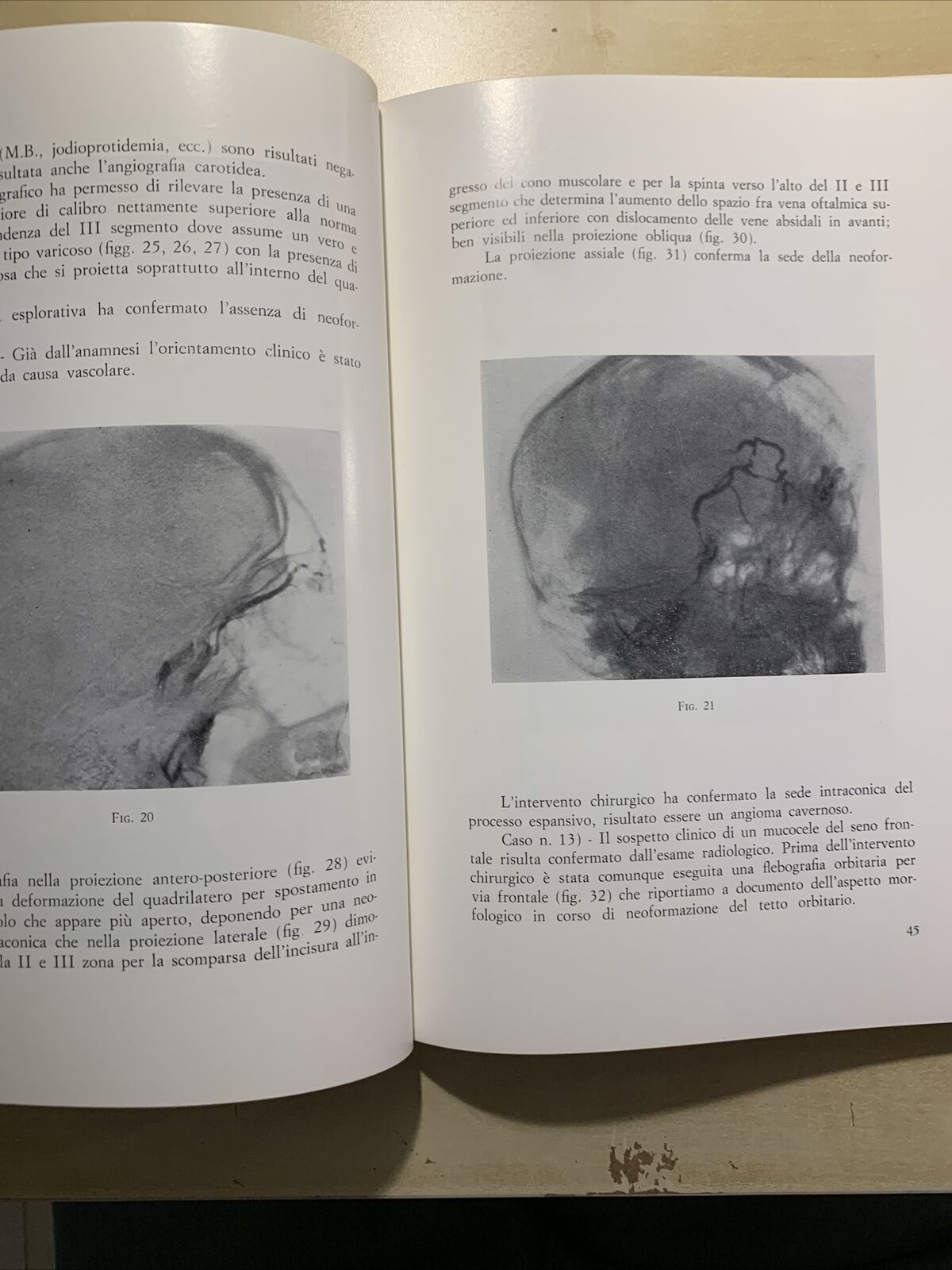 STATO ATTUALE DELLA FLEBOGRAFIA ORBITARIA - CRISTINI, CARAMAZZA, GIORDANO #