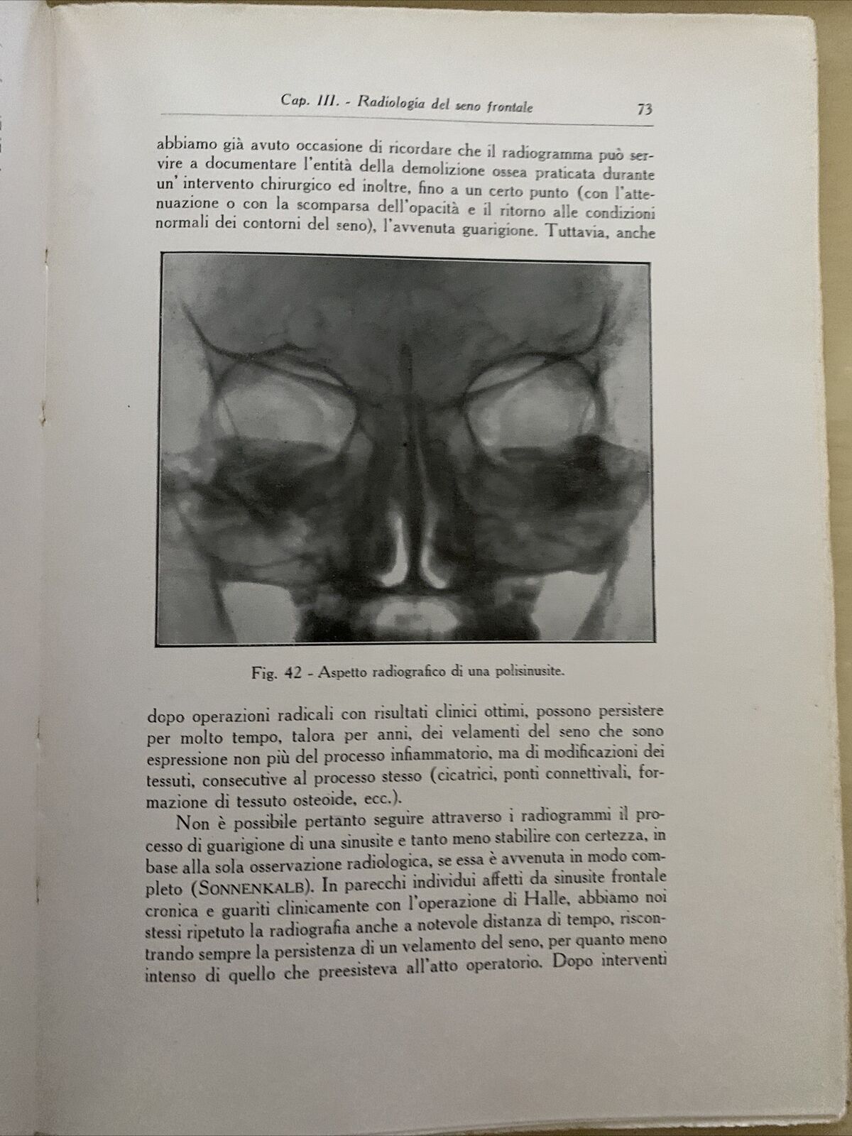 LA RADIOLOGIA IN OTORINO LARINGOLOGIA. G. LASCHI, VIGI. CAPPELLI 1931 #