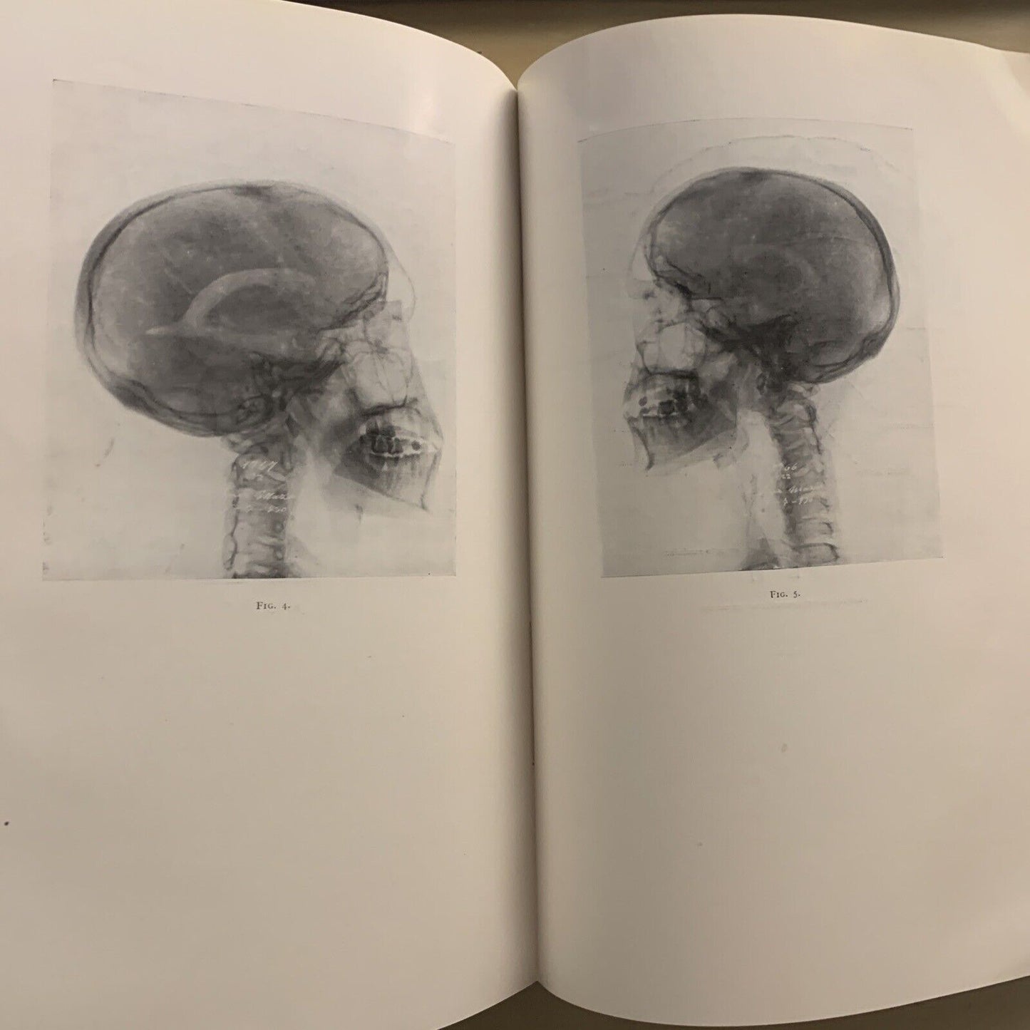TUBERCULOSIS DEL IRIS Y DEL CUERPO CILIAR - concilium ophtalmologicum 1933 #
