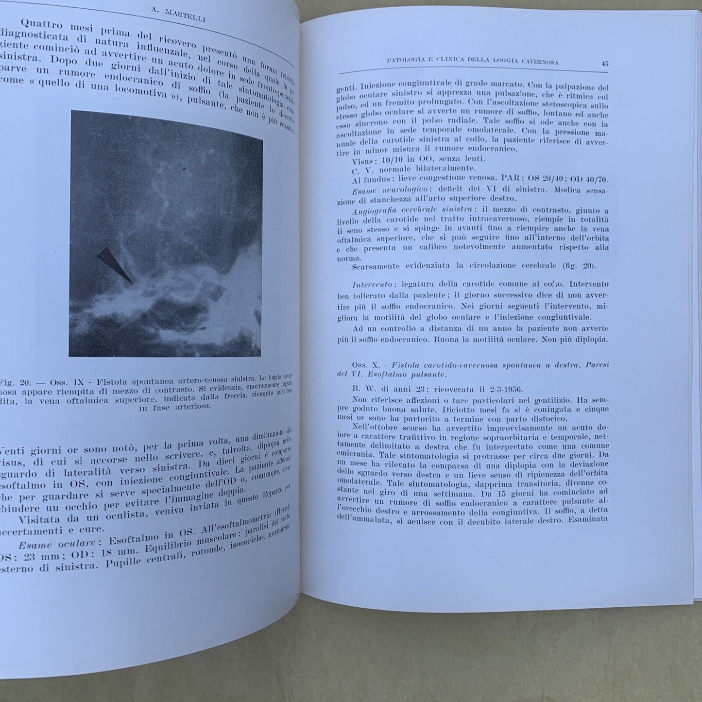 Patologia e clinica della loggia cavernosa, Aldo Martelli Oto neuro oftalmologia