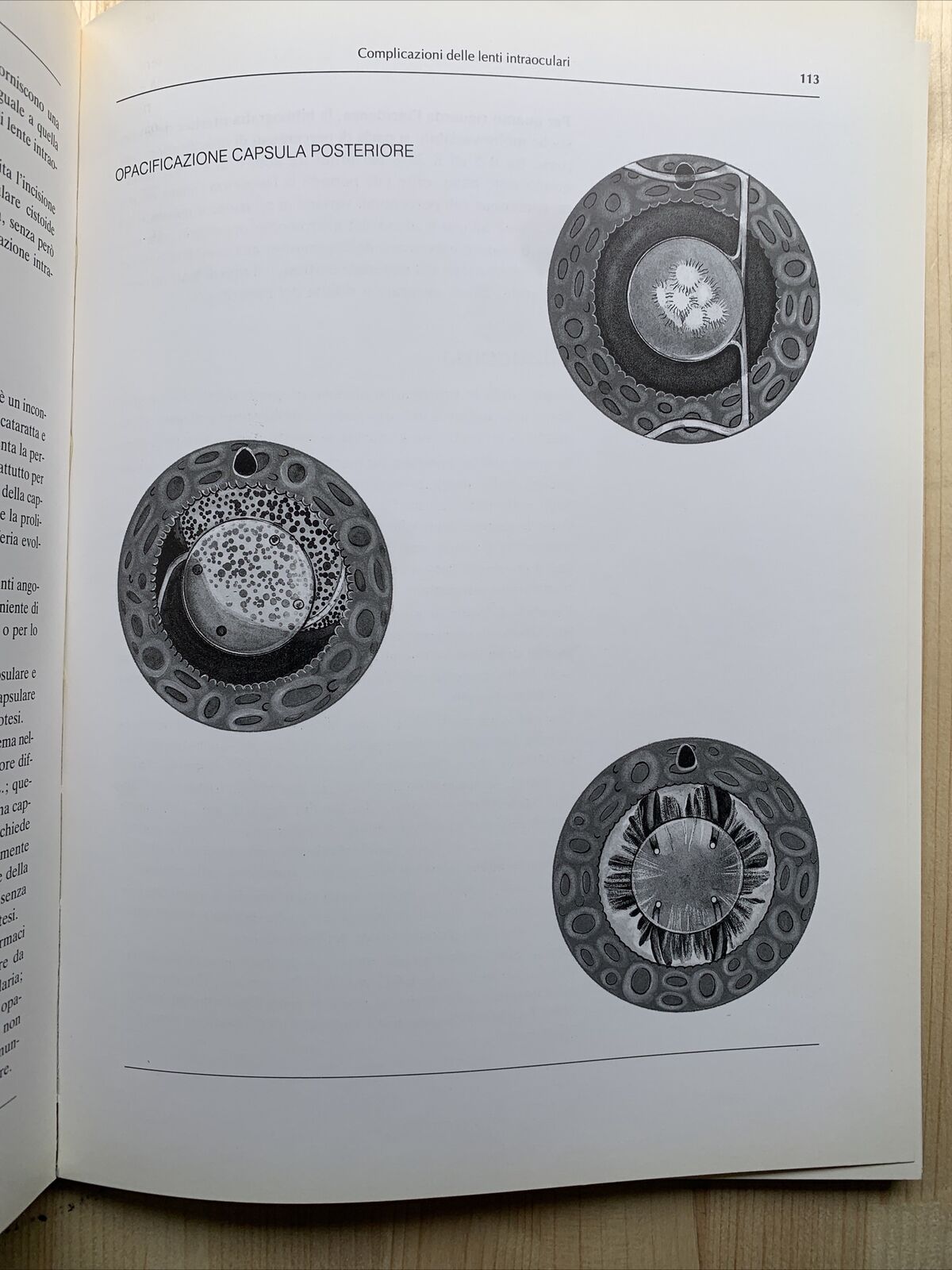 ATLANTE DI LENTI INTRAOCULARI - Lucio Buratto 1984 #