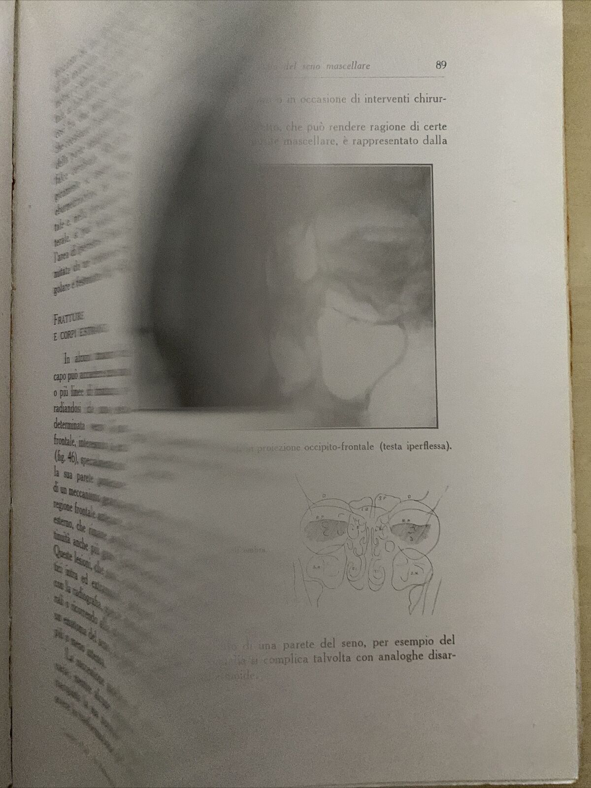 LA RADIOLOGIA IN OTORINO LARINGOLOGIA. G. LASCHI, VIGI. CAPPELLI 1931 #