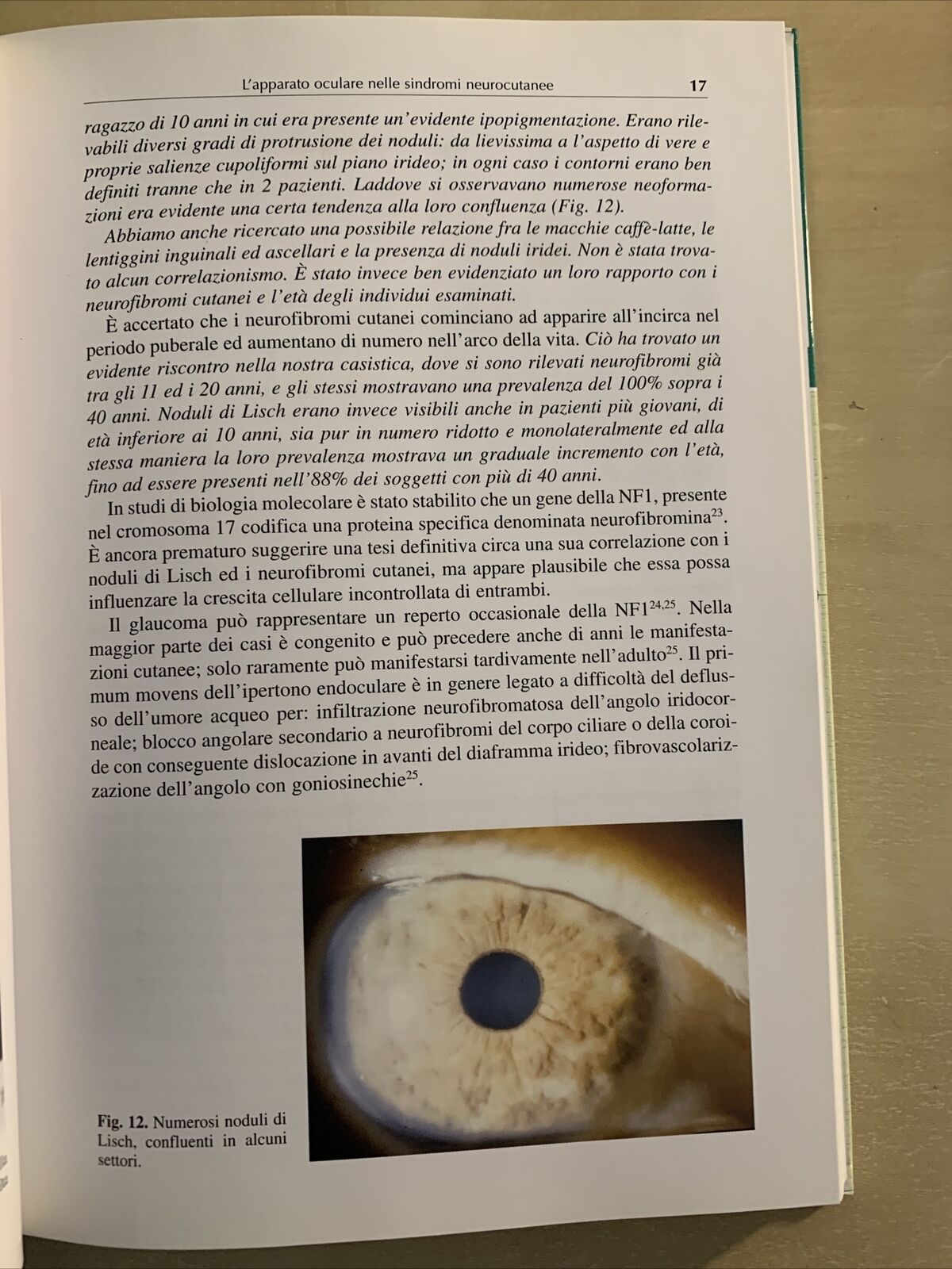 L'APPARATO OCULARE NELLE SINDROMI NEUROCUTANEE - Santi Maria recupero. Verduci #