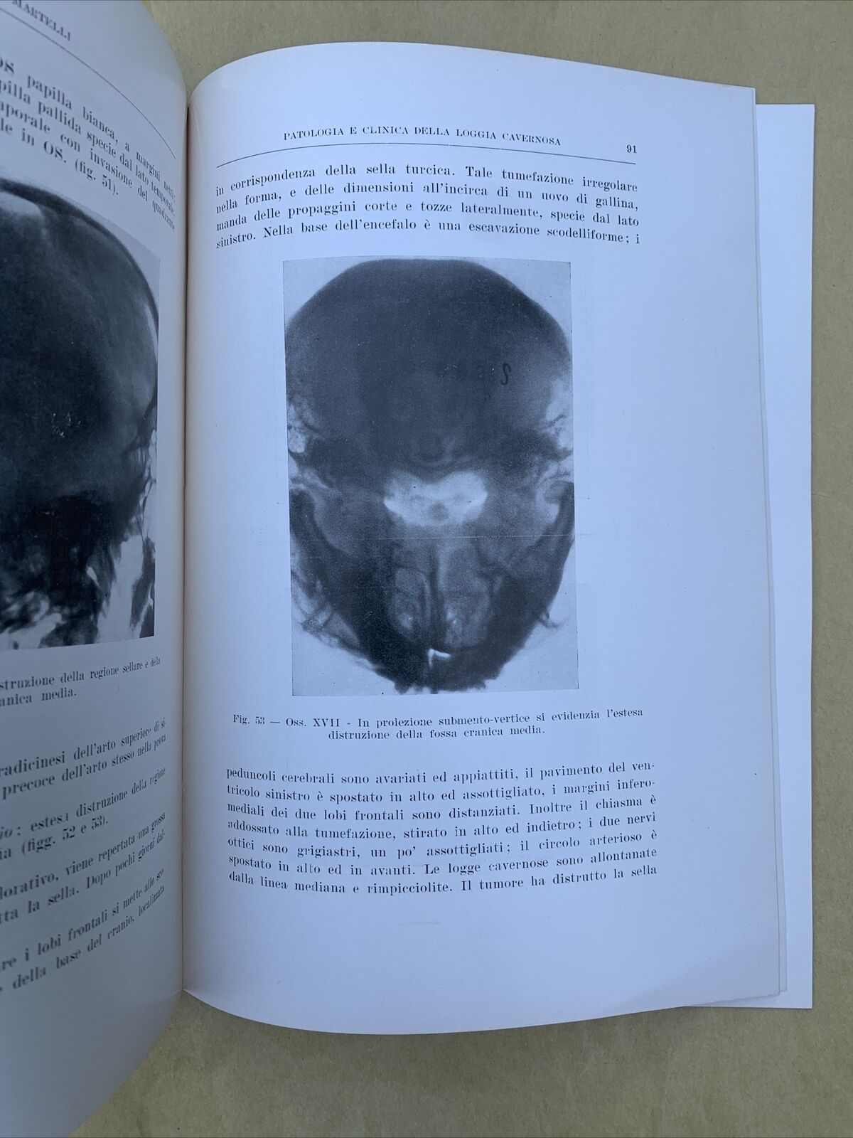 Patologia e clinica della loggia cavernosa, Aldo Martelli Oto neuro oftalmologia