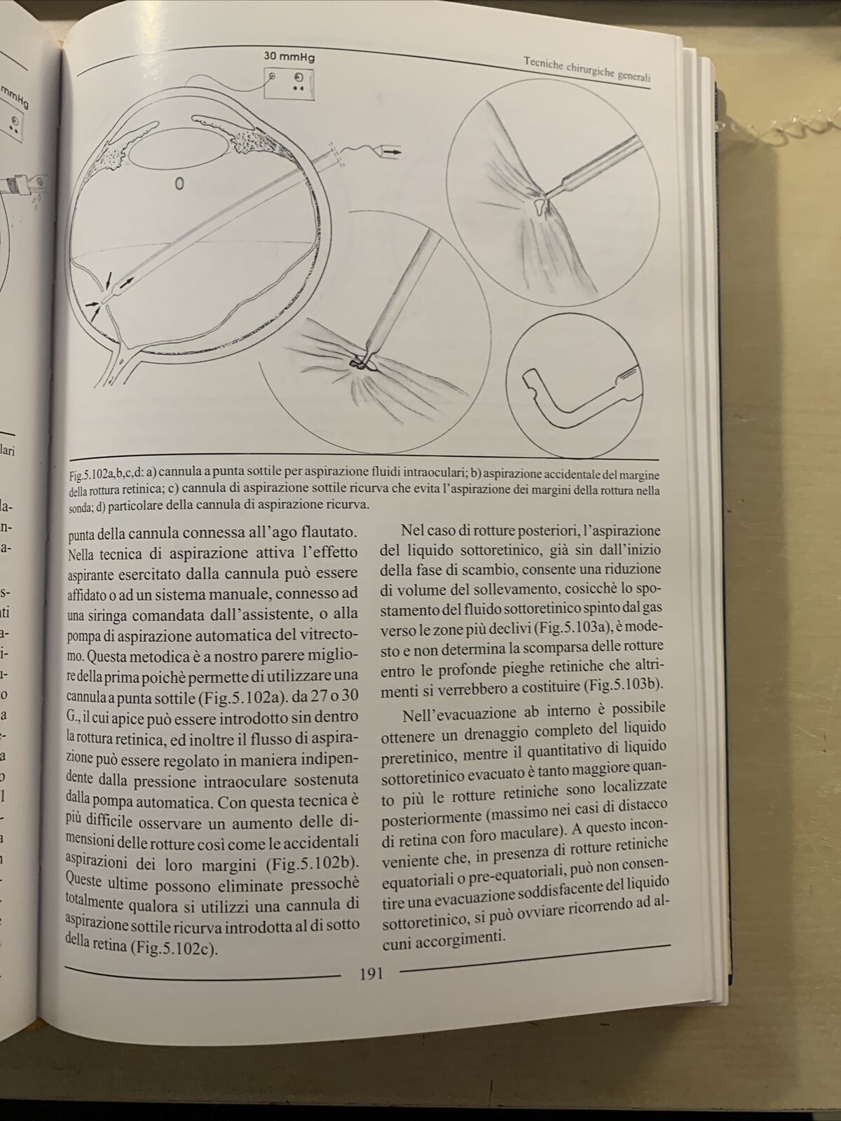 LA CHIRURGIA VITREORETINICA NEL DISTACCO DI RETINA REGMATOGENO. Molfetta Ghedini
