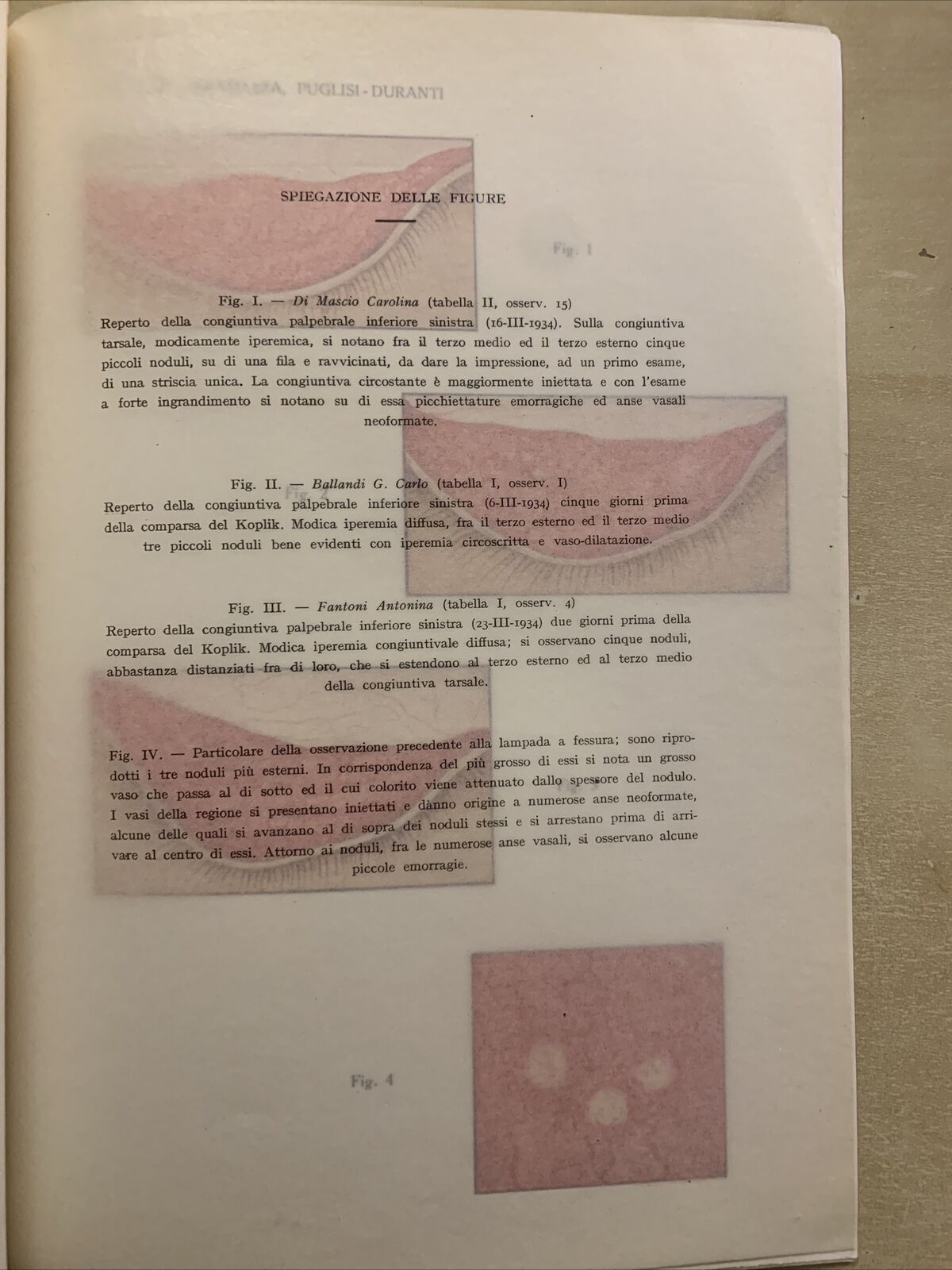 Le manifestazioni congiuntivali del morbillo con riguardo all'incubazione 1935 #