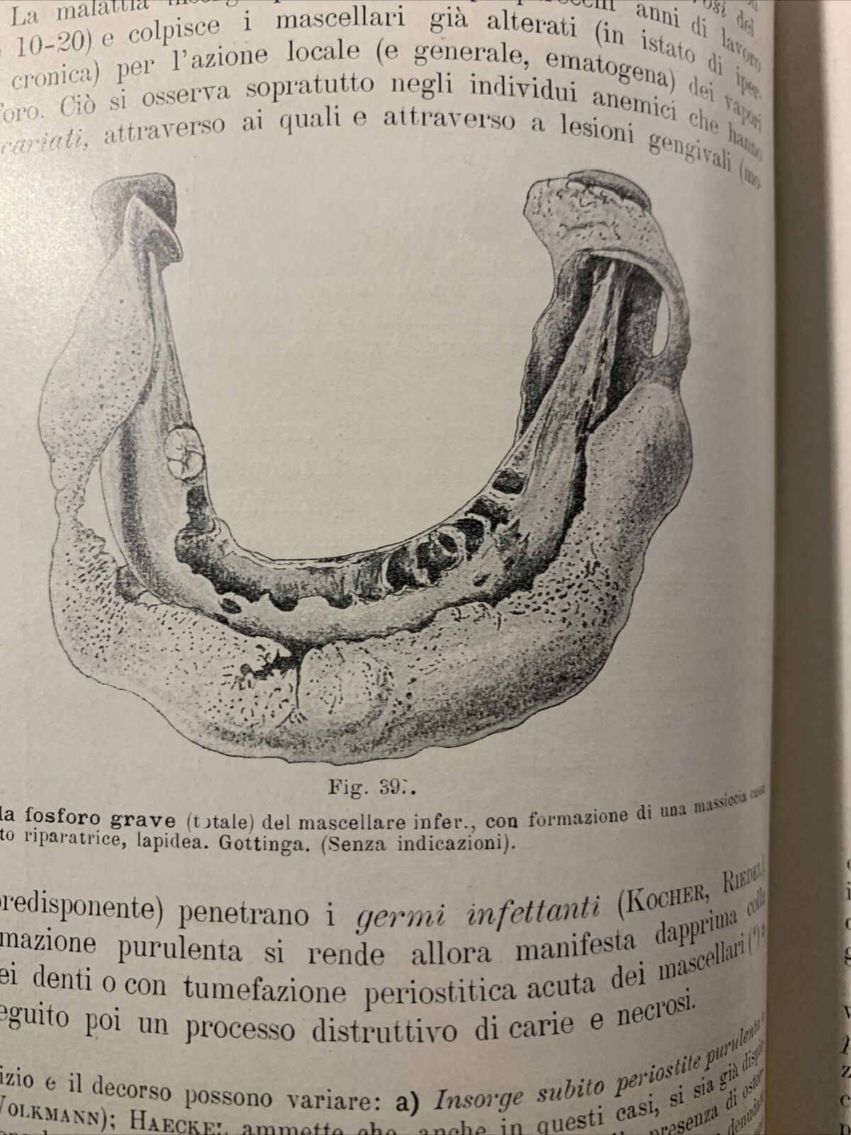 Trattato di ANATOMIA PATOLOGICA SPECIALE - Kaufmann E. Vallardi 1913 2 voll. #