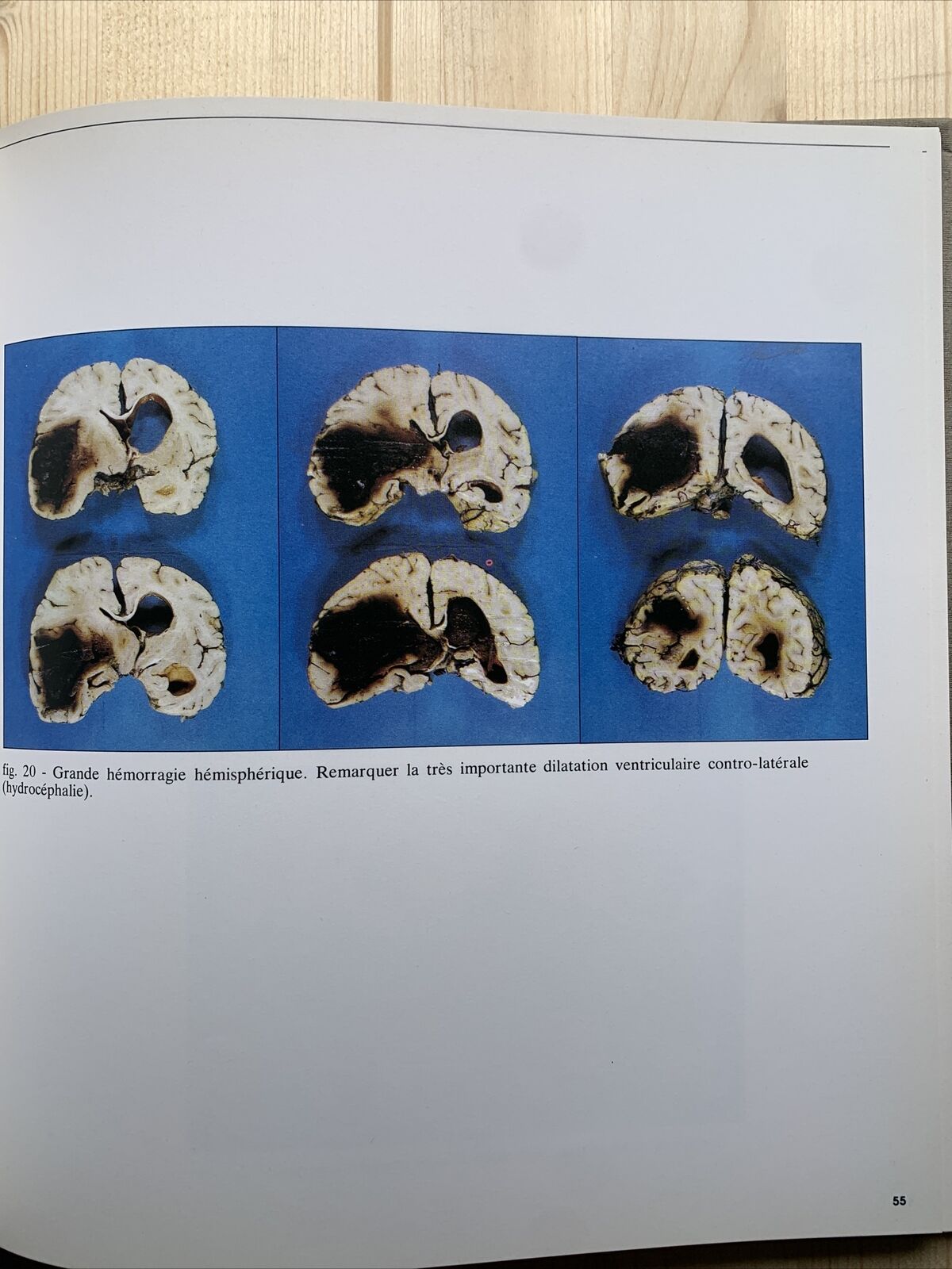 Redécouverte du micro anéurysme - Robert et Carrière, hypertension artirielle #