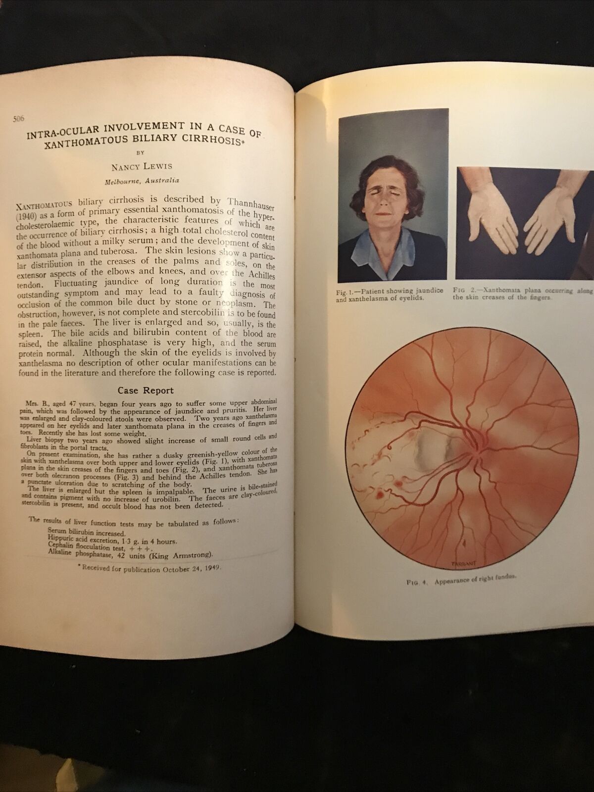 BRITISH JOURNAL OF OPHTHALMOLOGY oftalmologia, vol. XXXIV 1950 - S. Duke-Elder