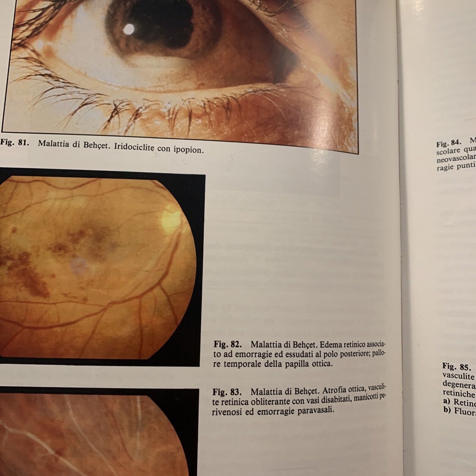LE FLOGOSI UVEALI - PIVETTI PEZZI, MASSON 1987 #
