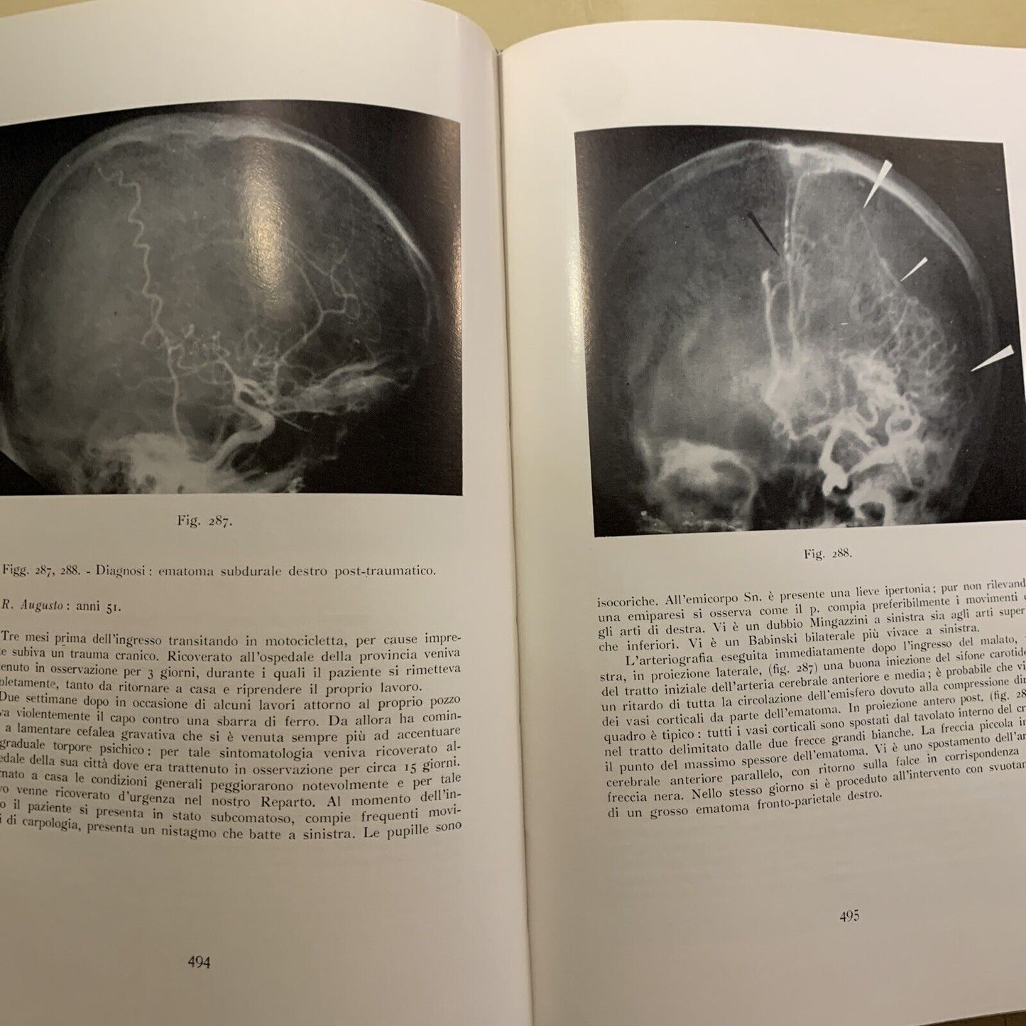 ANGIOGRAFIA CEREBRALE - MARIO MILLETTI, VOLUME PRIMO. LUIGI PARMA 1959
