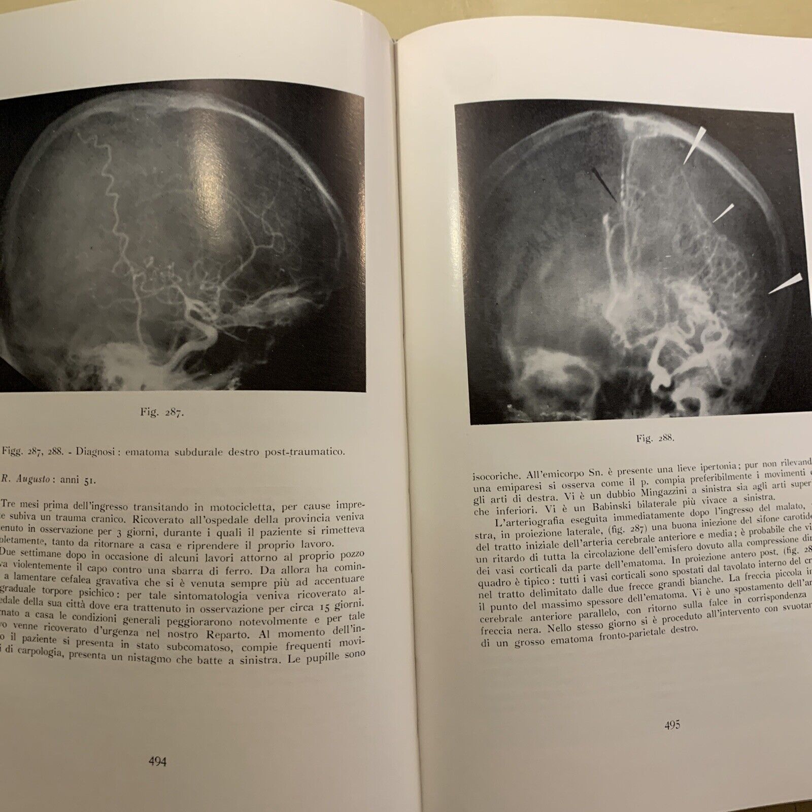 ANGIOGRAFIA CEREBRALE - MARIO MILLETTI, VOLUME PRIMO. LUIGI PARMA 1959