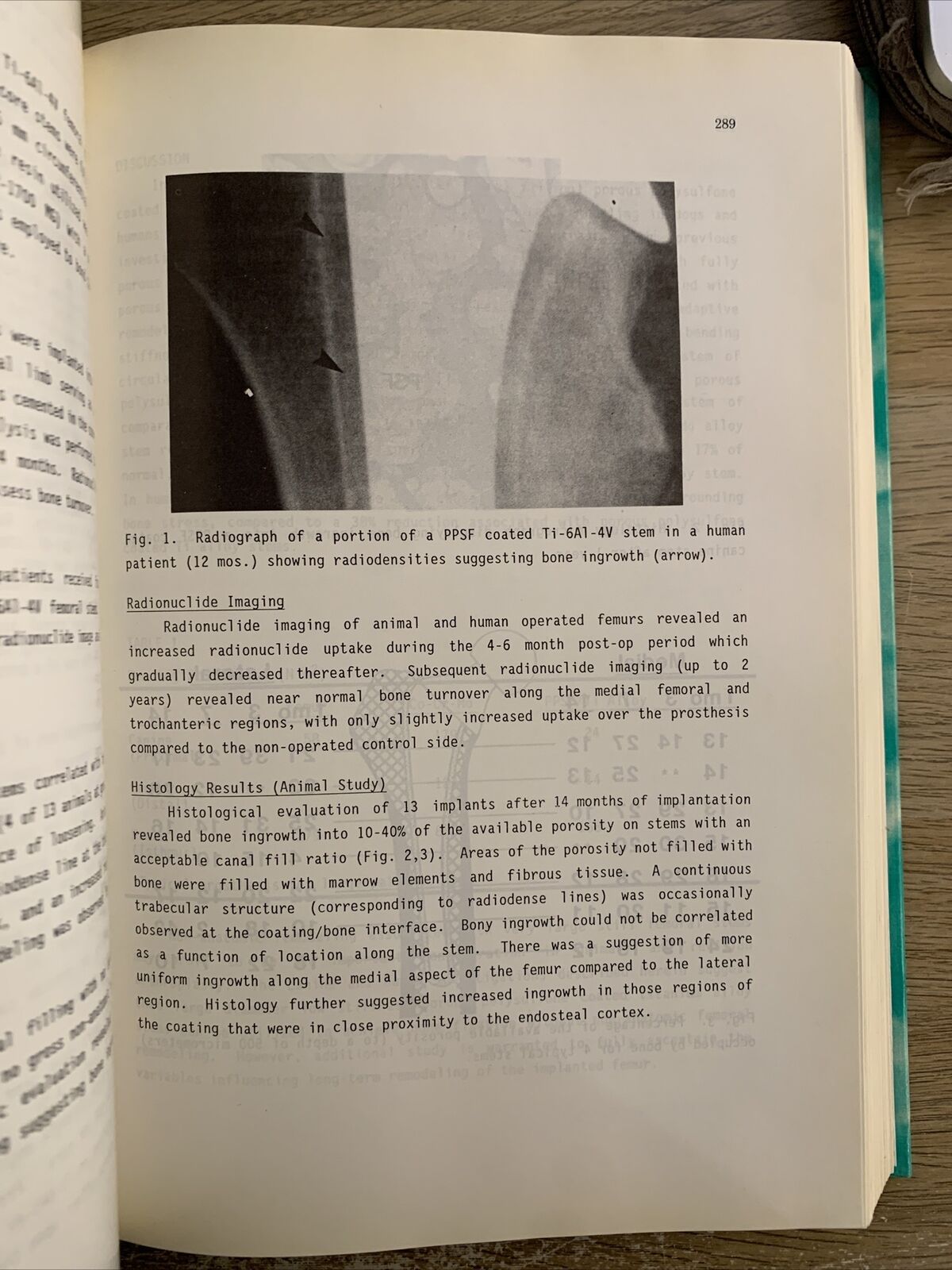 Biomaterials and clinical applications. Pizzoferrato , Marchetti, Ravaglioli.