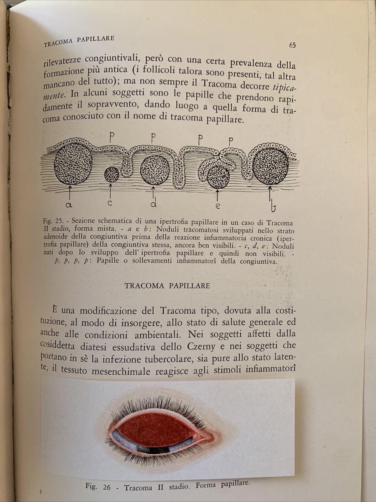 IL TRACOMA - BARDELLI , MARZOCCO 1940