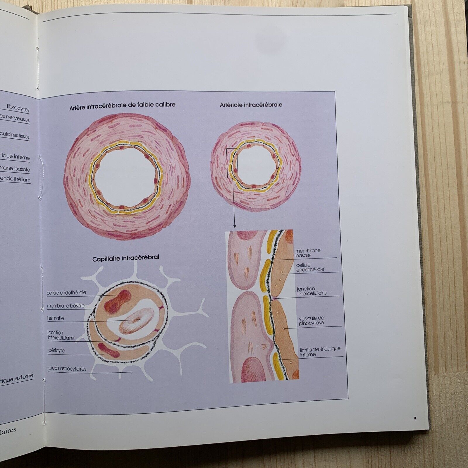 Redécouverte du micro anéurysme - Robert et Carrière, hypertension artirielle #