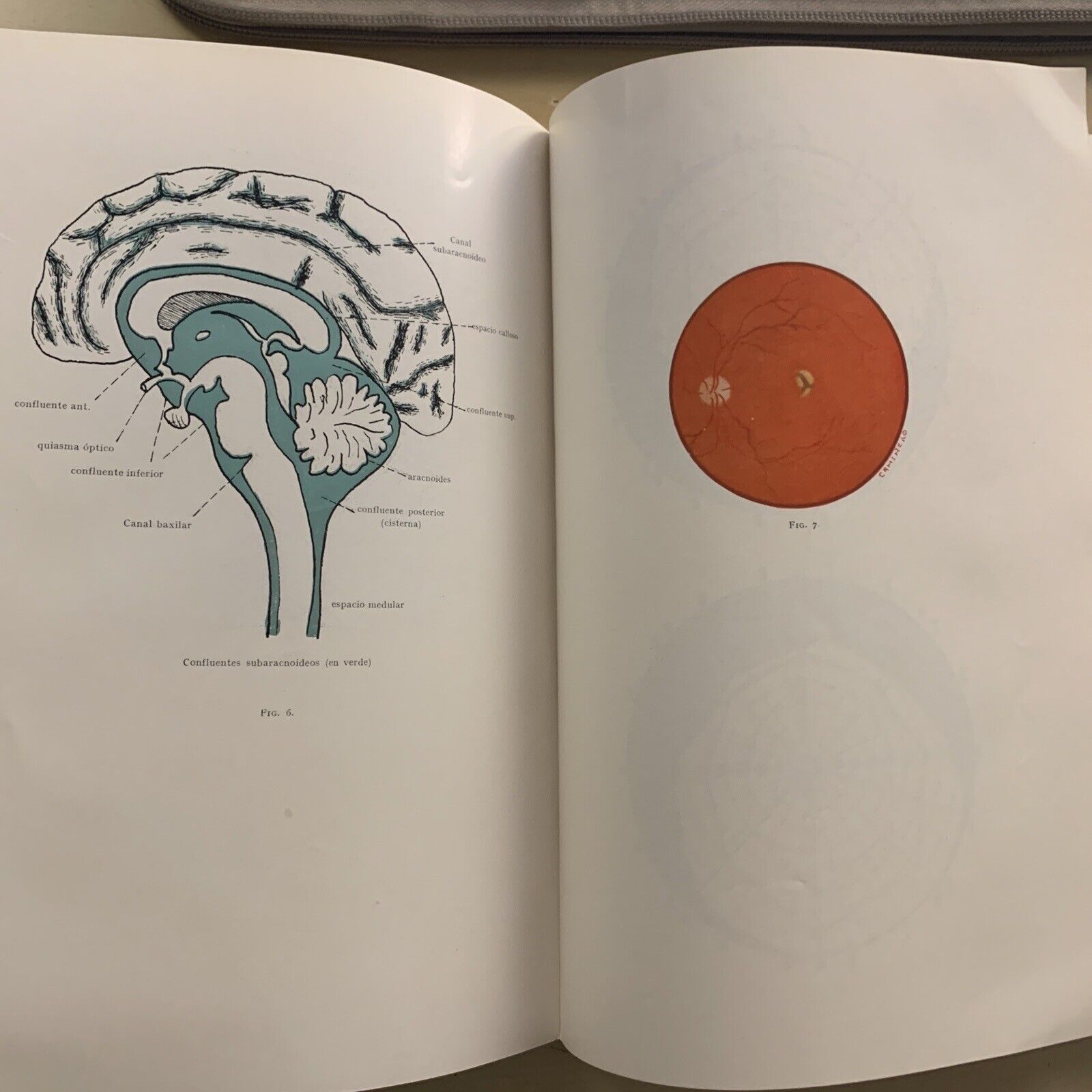 TUBERCULOSIS DEL IRIS Y DEL CUERPO CILIAR - concilium ophtalmologicum 1933 #