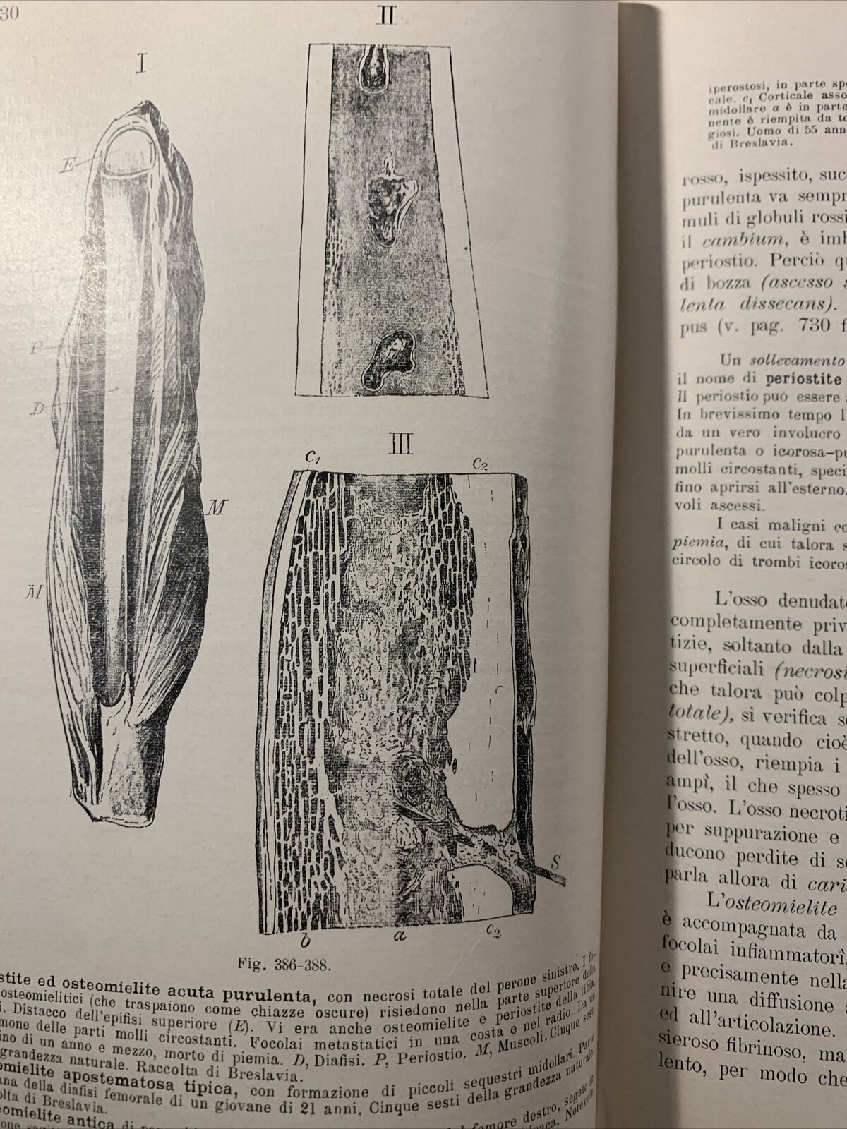 Trattato di ANATOMIA PATOLOGICA SPECIALE - Kaufmann E. Vallardi 1913 2 voll. #