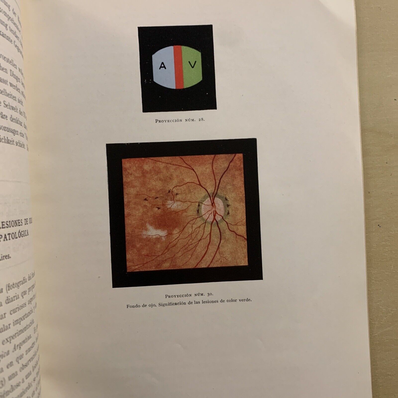 TUBERCULOSIS DEL IRIS Y DEL CUERPO CILIAR - concilium ophtalmologicum 1933 #