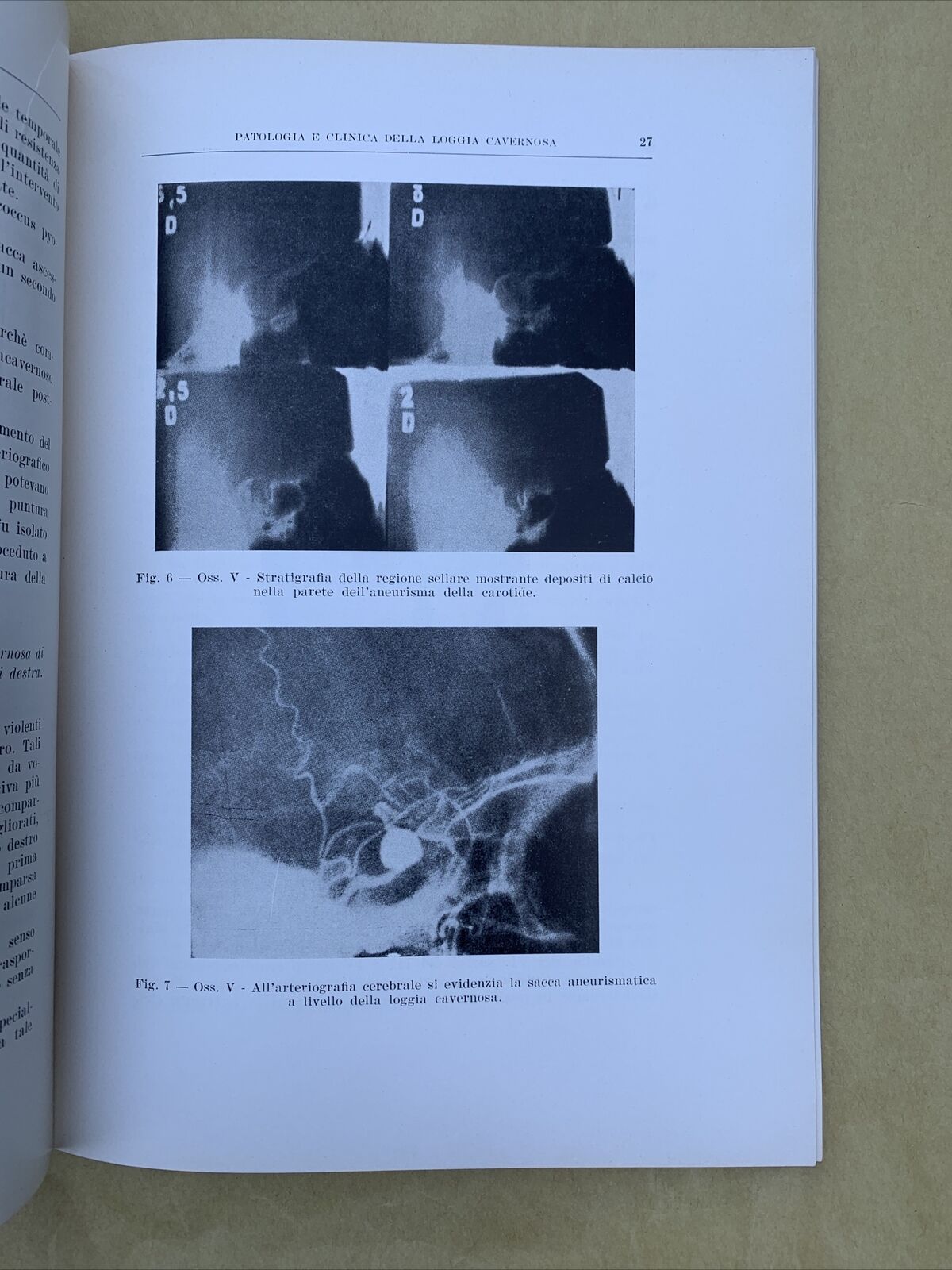 Patologia e clinica della loggia cavernosa, Aldo Martelli Oto neuro oftalmologia