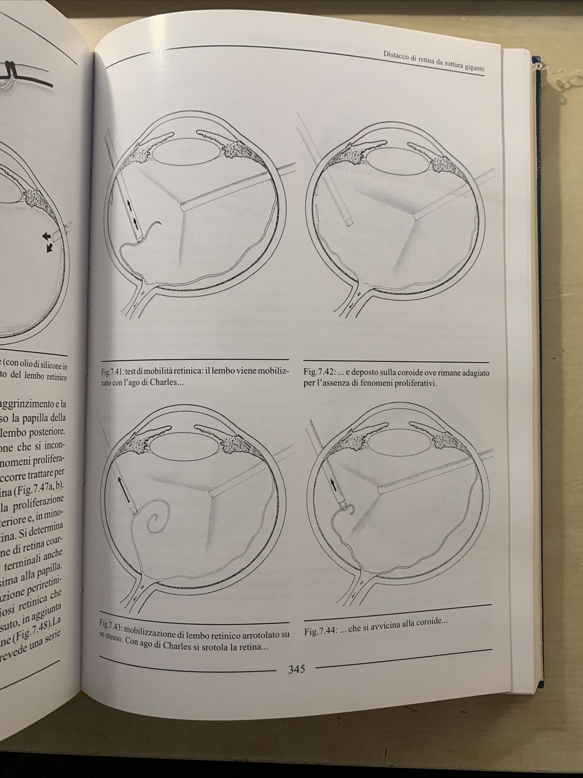 LA CHIRURGIA VITREORETINICA NEL DISTACCO DI RETINA REGMATOGENO. Molfetta Ghedini