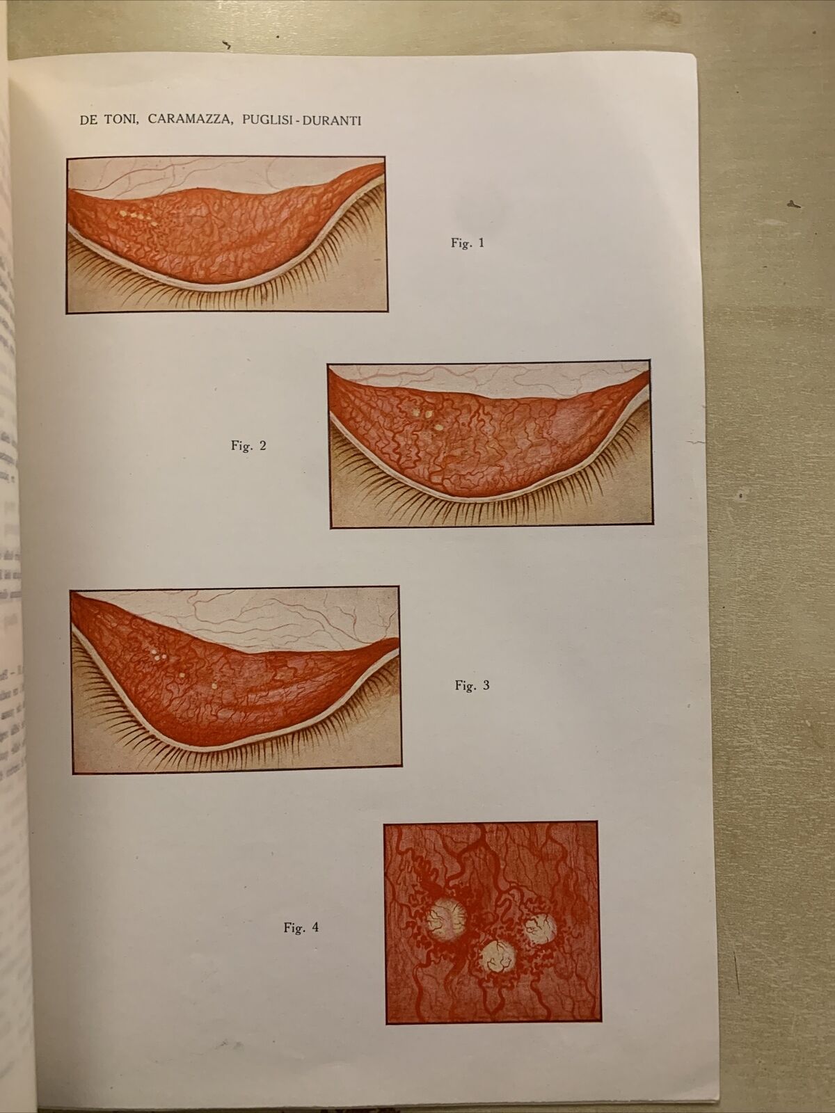 Le manifestazioni congiuntivali del morbillo con riguardo all'incubazione 1935 #