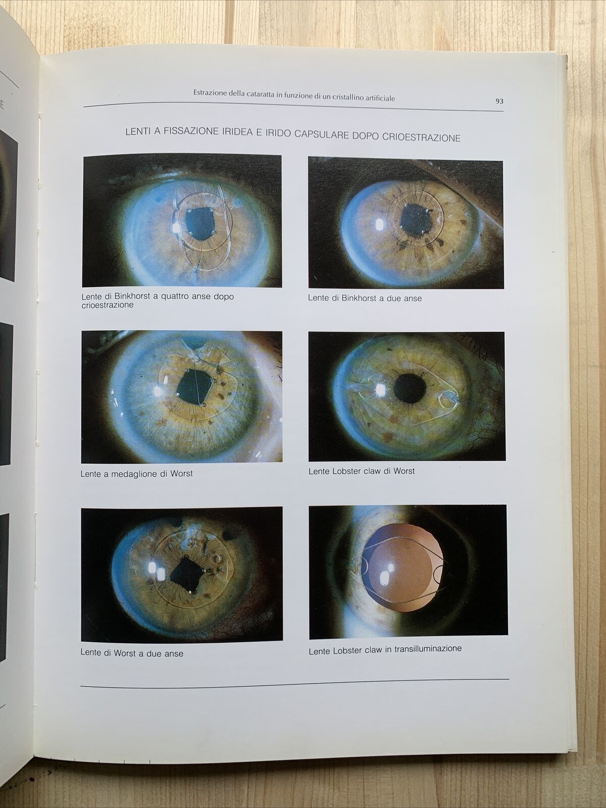 ATLANTE DI LENTI INTRAOCULARI - Lucio Buratto 1984 #