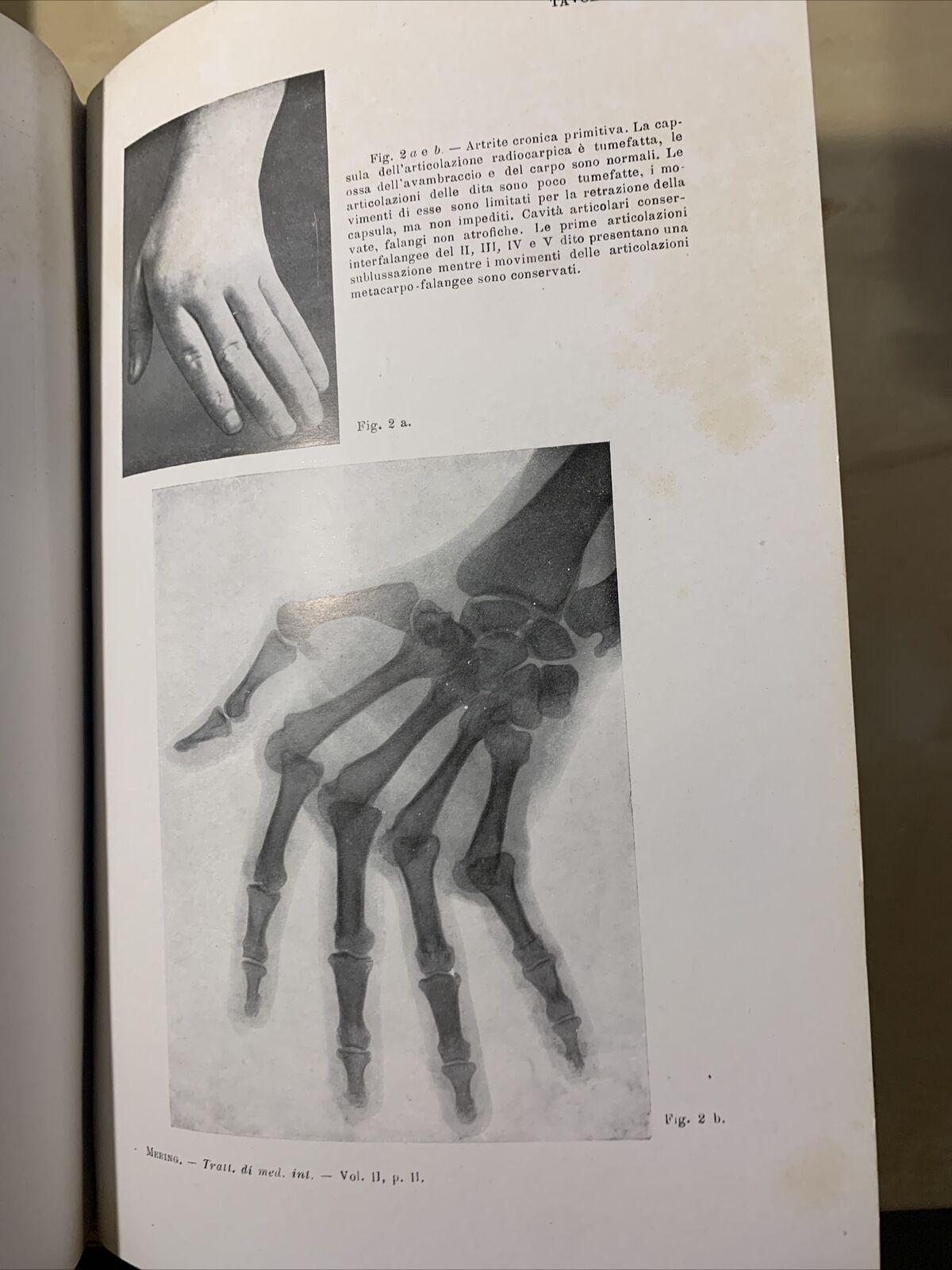 TRATTATO DELLE MALATTIE INTERNE, J. v. Mering. Società Editrice Libraria 1926