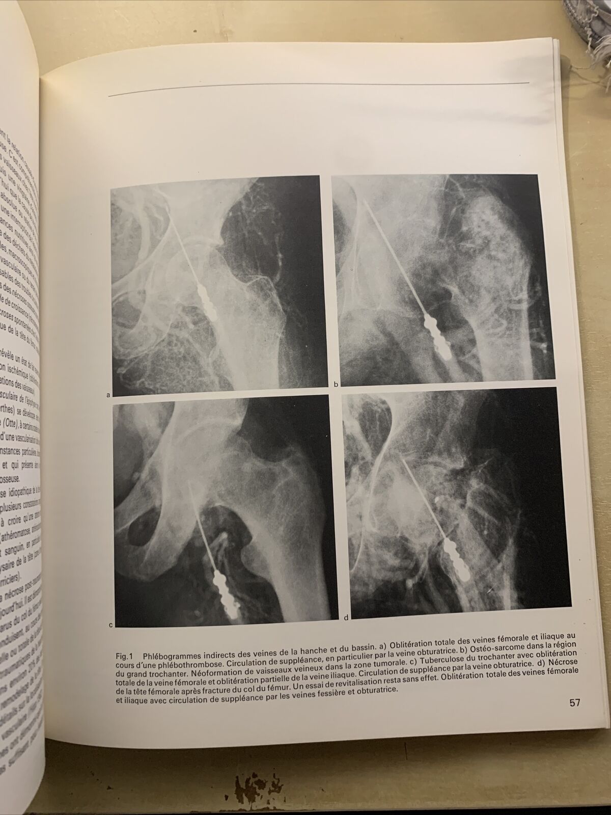 FORUM MEDICI - LES MÉDICINS PARLENT AU MÉDECIN, No 14 La phlébologie et les doma